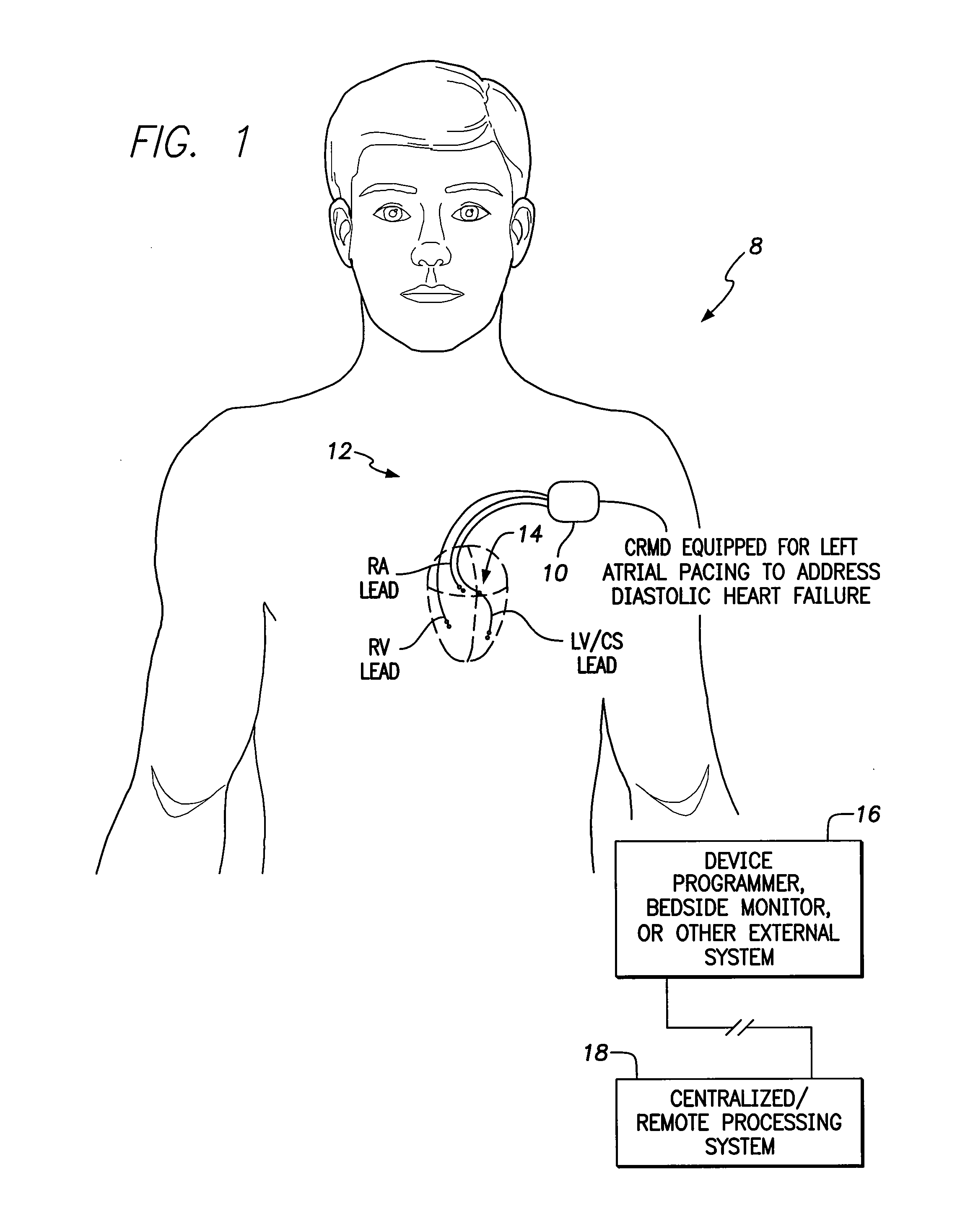 System and method for left atrial pacing in patients with diastolic heart failure