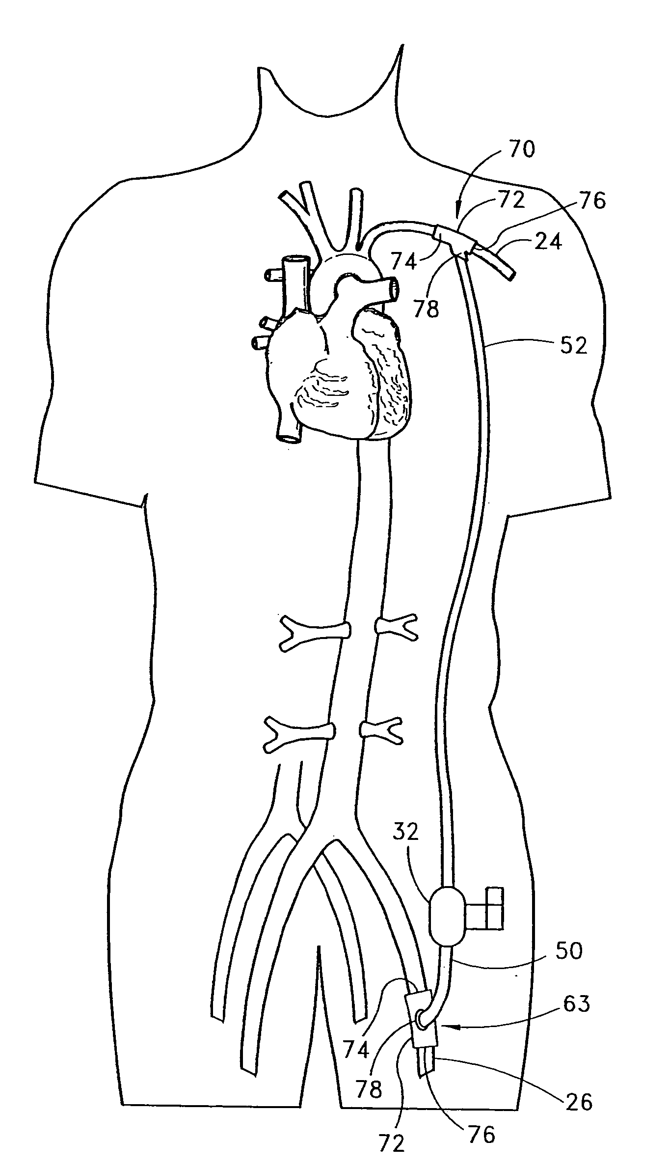 Implantable heart assist system and method of applying same