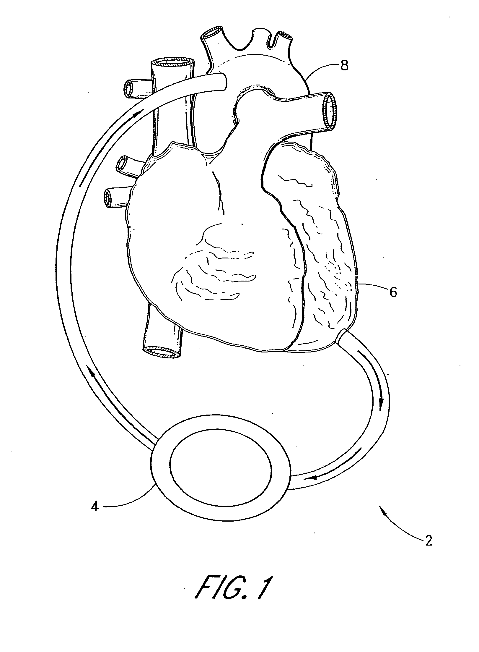 Implantable heart assist system and method of applying same