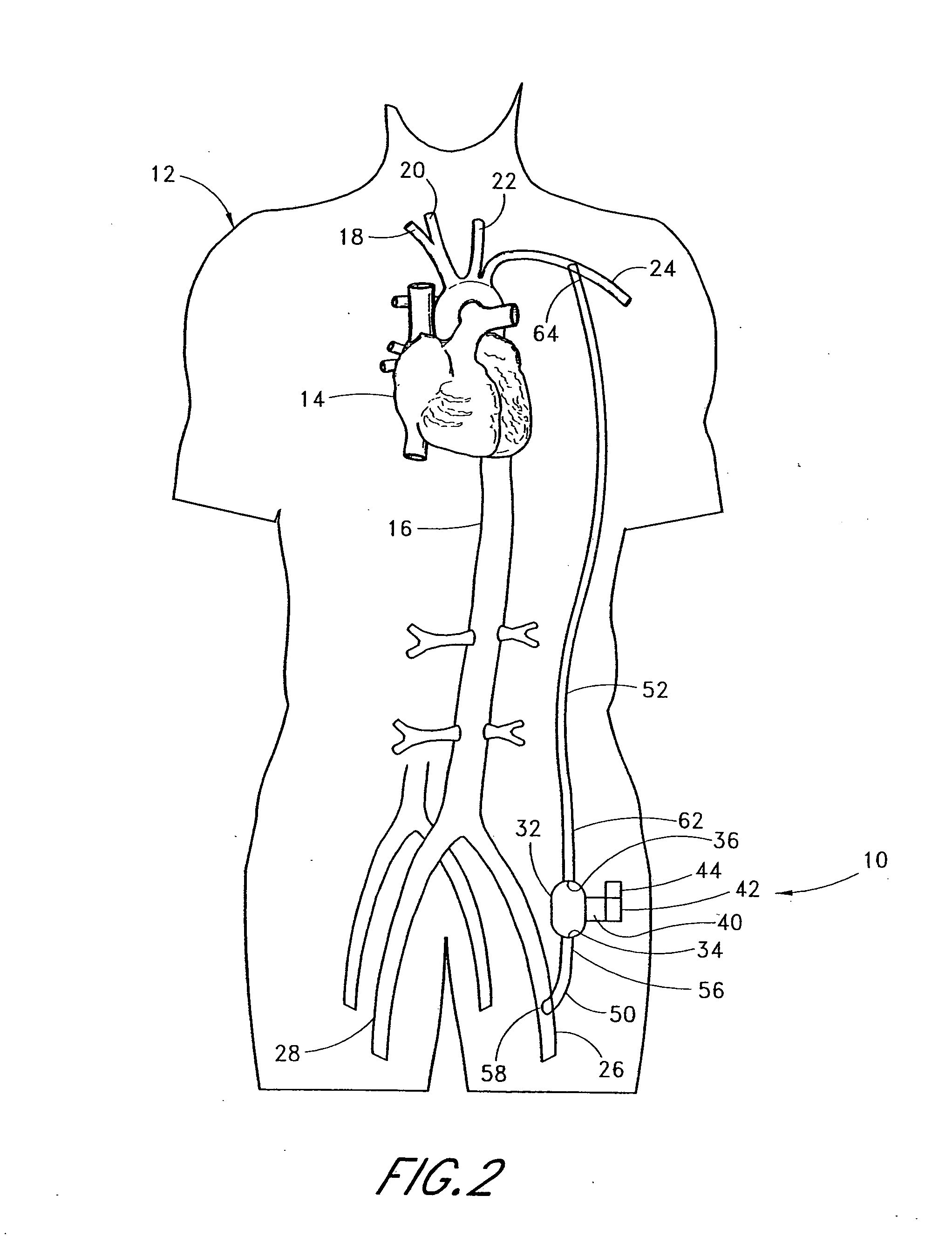 Implantable heart assist system and method of applying same