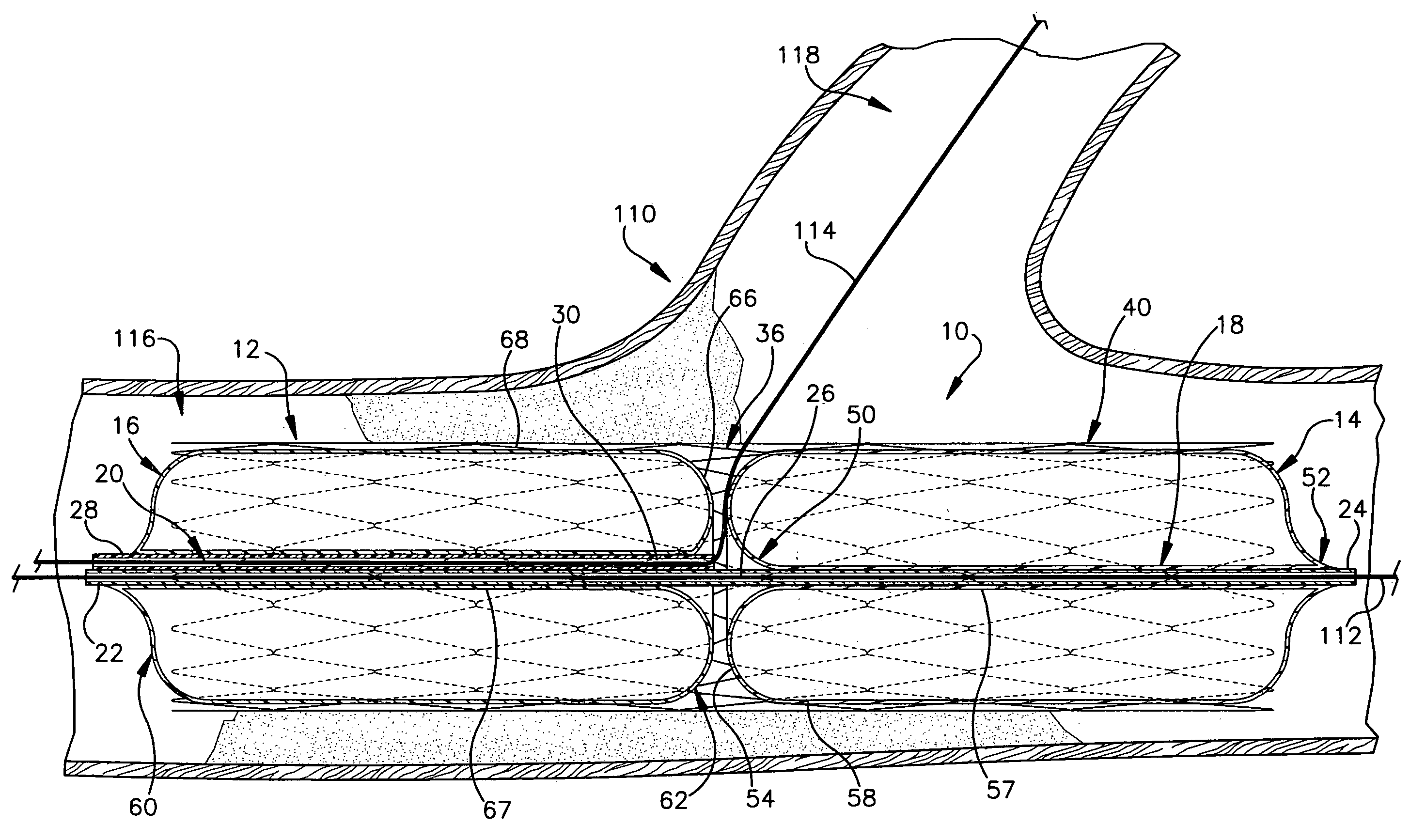 Apparatus for treating atherosclerosis