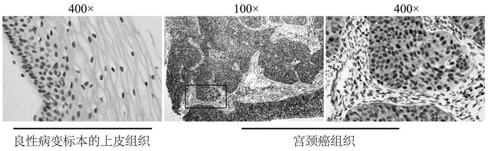 Use of Kin17 gene or protein in preparation of cervical cancer diagnosis and treatment medicaments