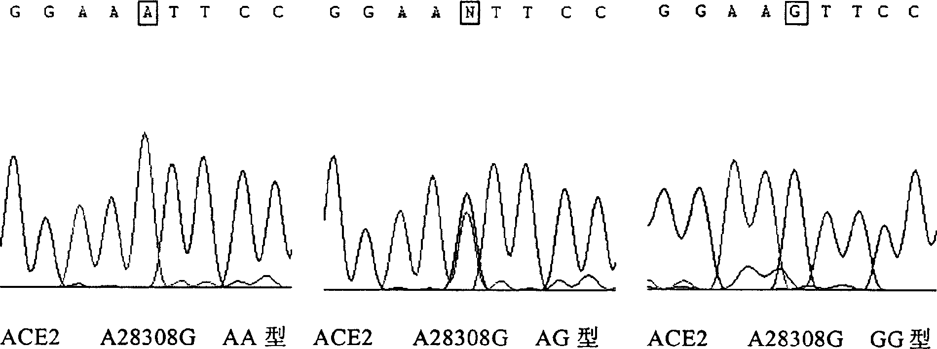 Relativity of proangiotension transferase 2 gene and prinary hypertension