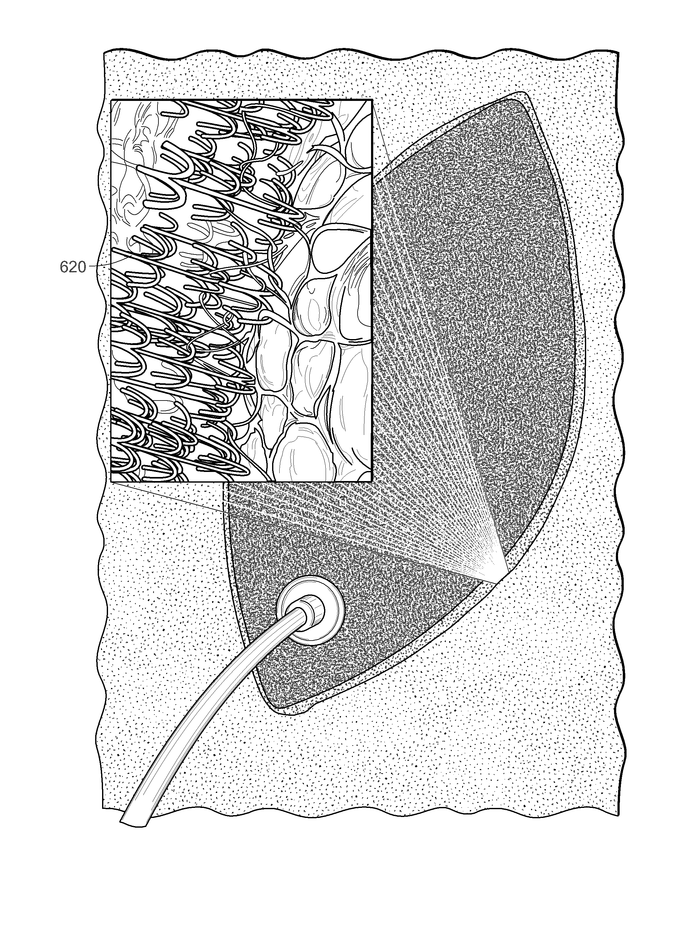 Negative pressure wound closure device