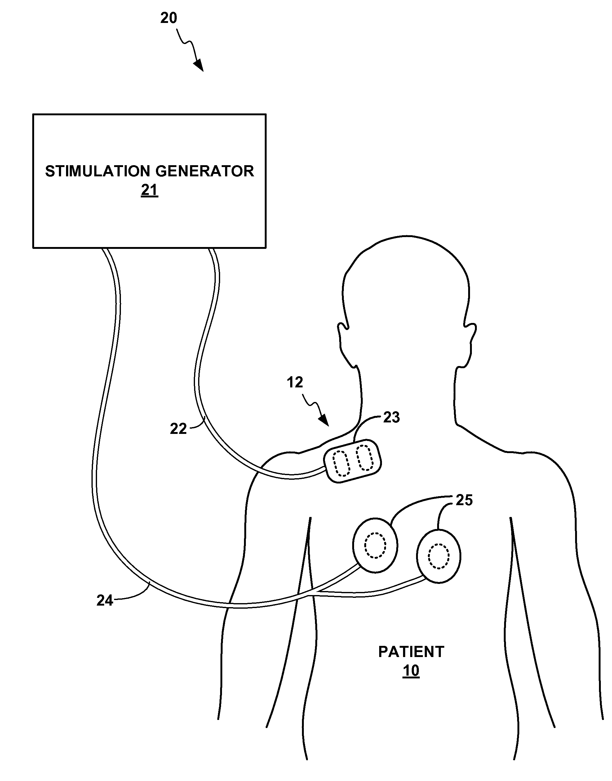 Subclavian ansae stimulation