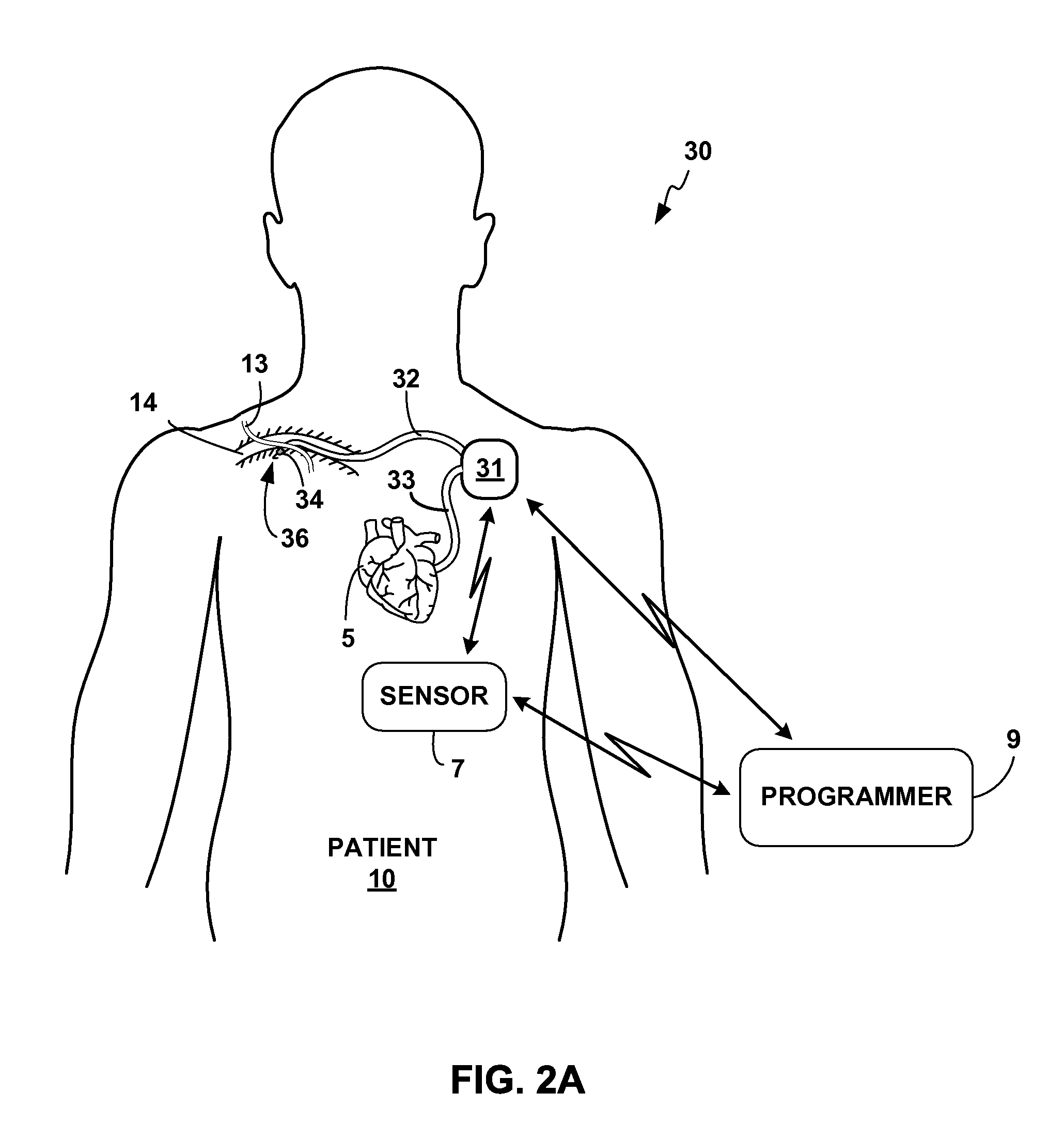 Subclavian ansae stimulation