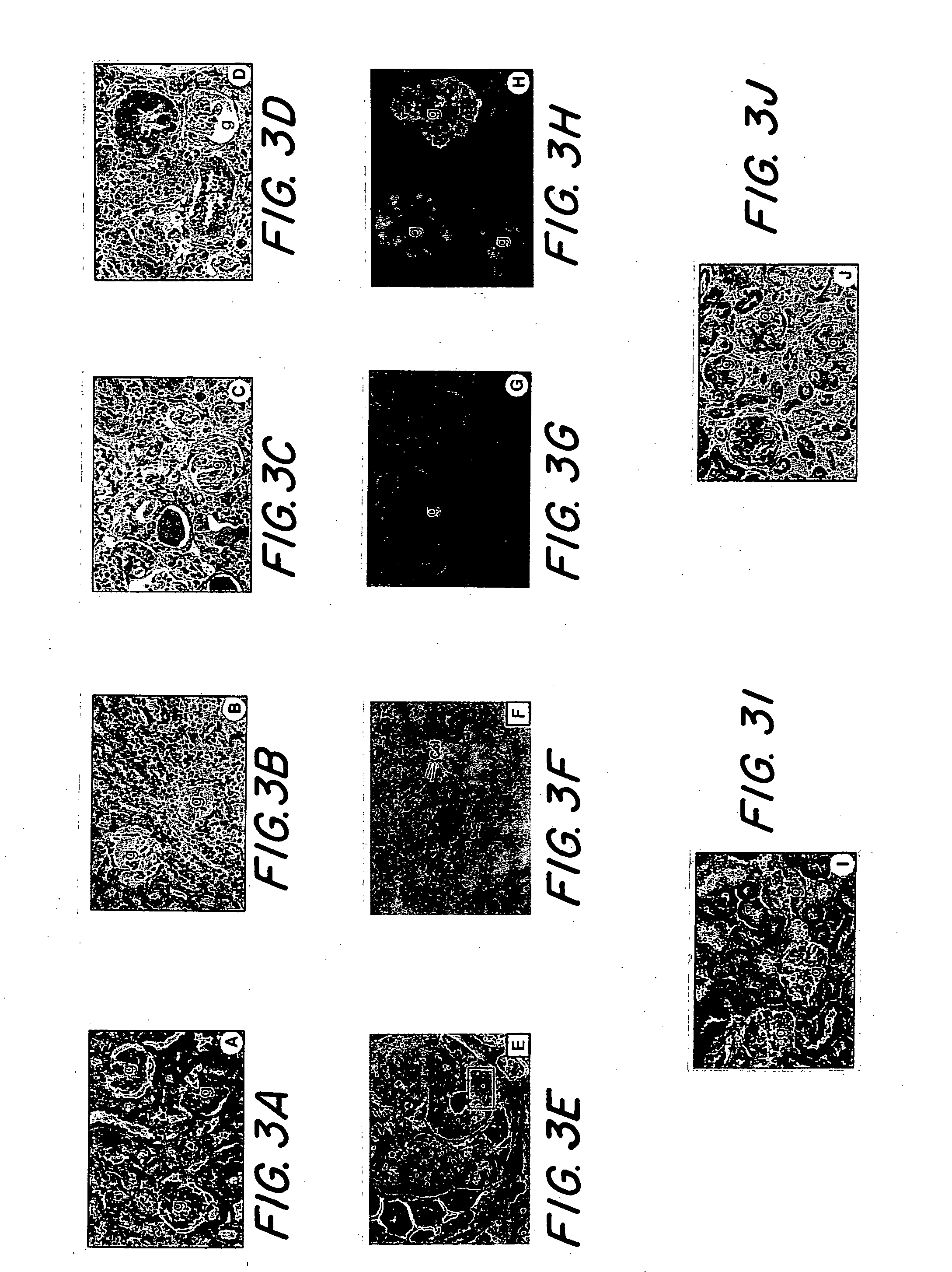 Use of recombinant human uteroglobin in treatment of inflammatory and fibrotic conditions