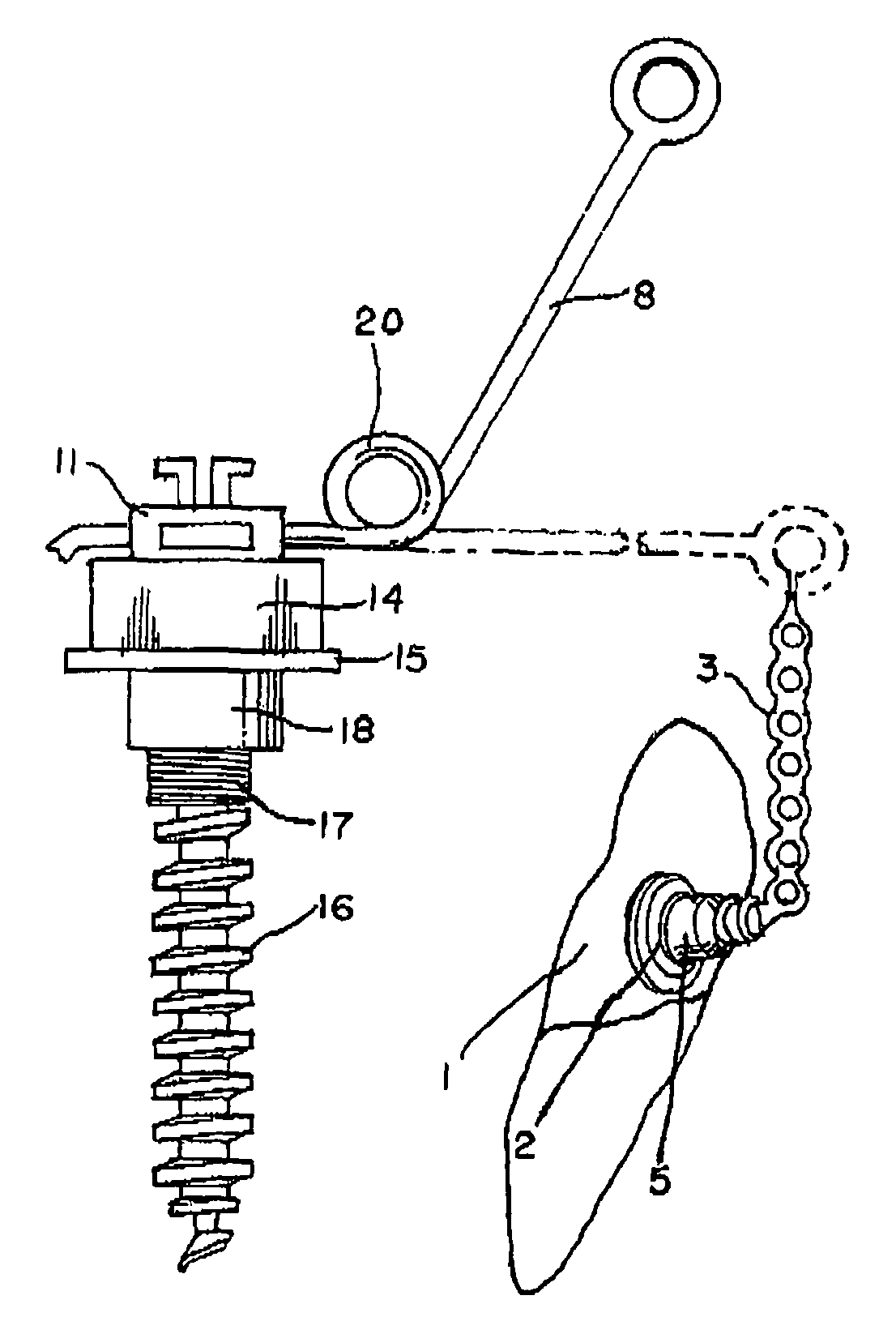 Impacted tooth appliance