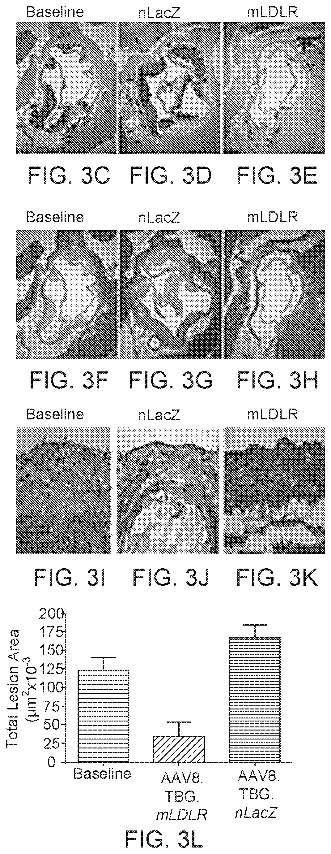 Gene therapy for treating familial hypercholesterolemia