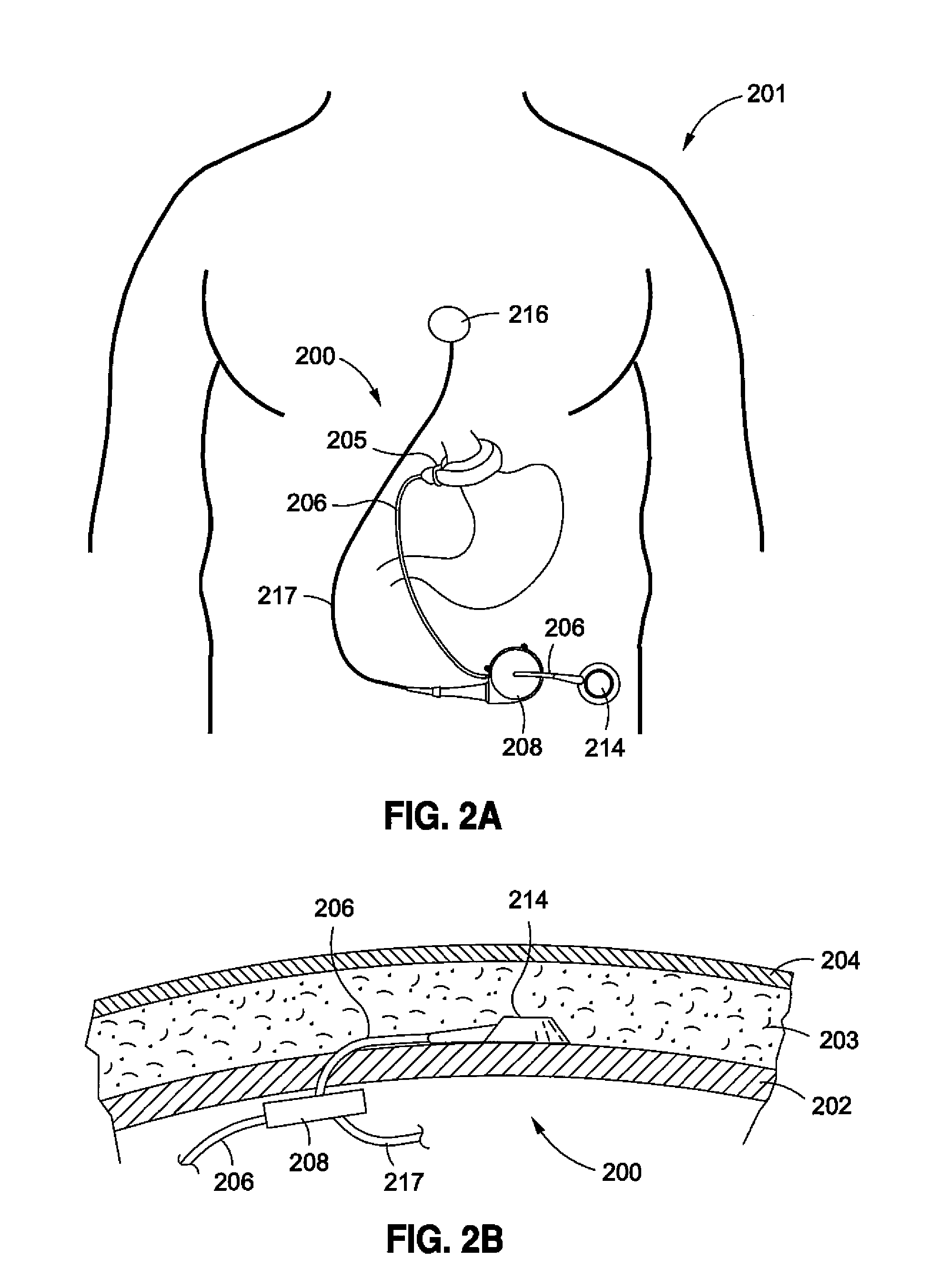 Remotely adjustable gastric banding system