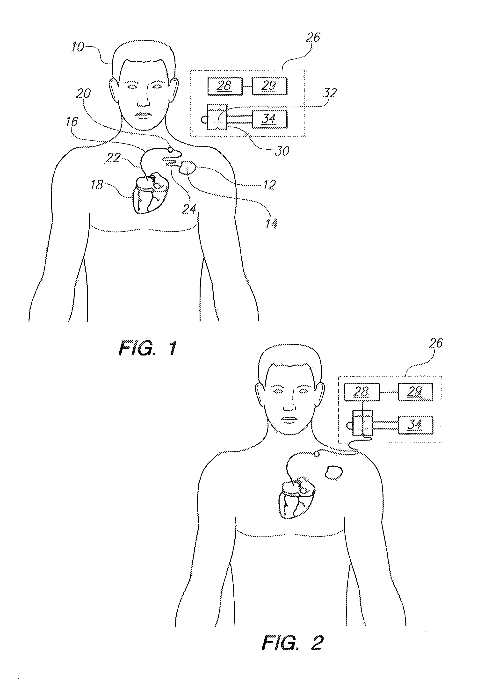 Extracorporeal Unit for Inspecting the Insulation of an Electrical Wire of an Implanted Medical Device