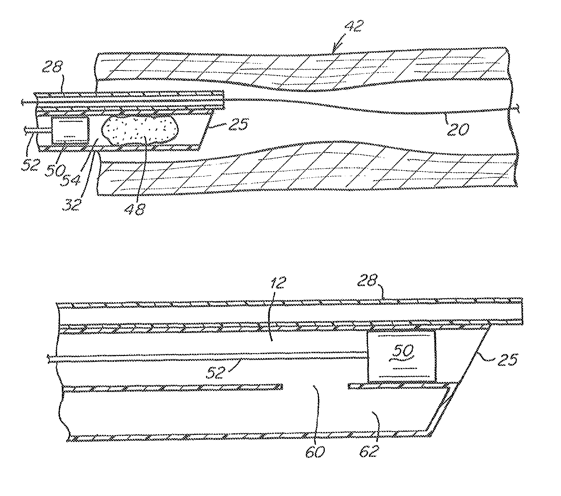 Aspiration catheter having variable volume distal suction chamber