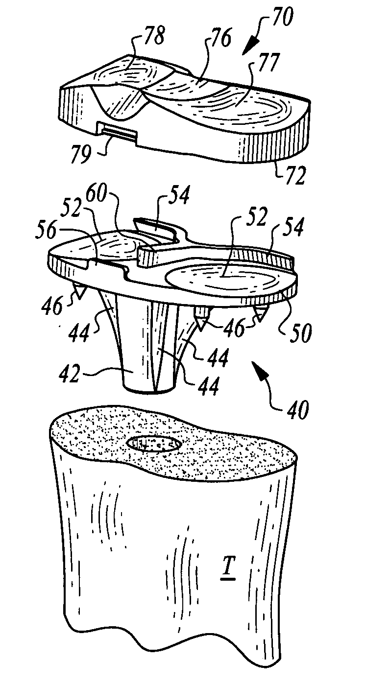 Femoral component of an artificial knee joint