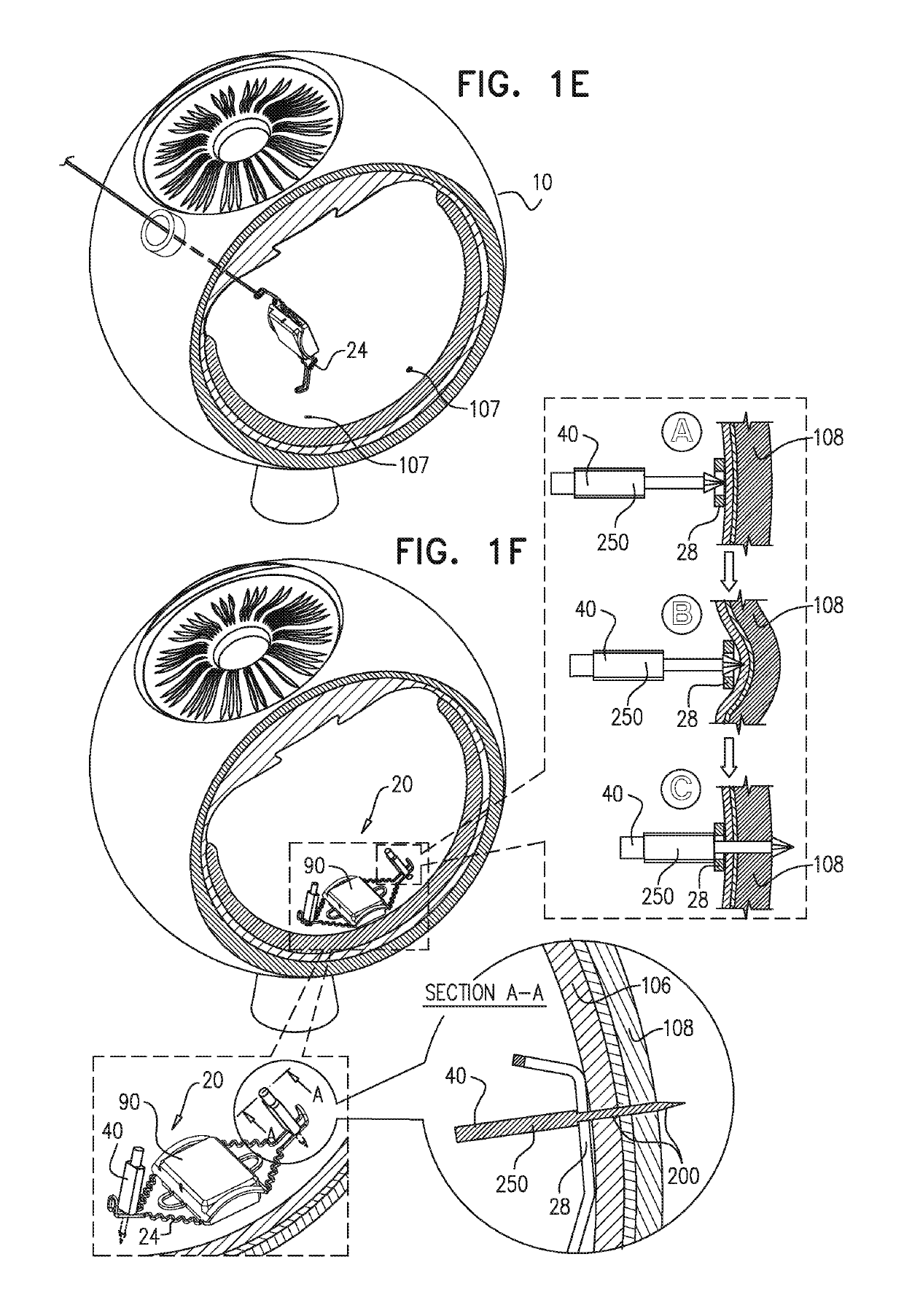 Retinal implant fixation