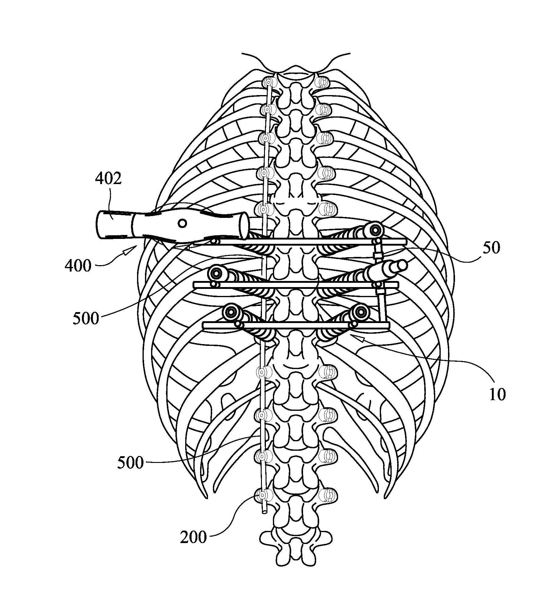 Systems, Assemblies and Methods for Spinal Derotation