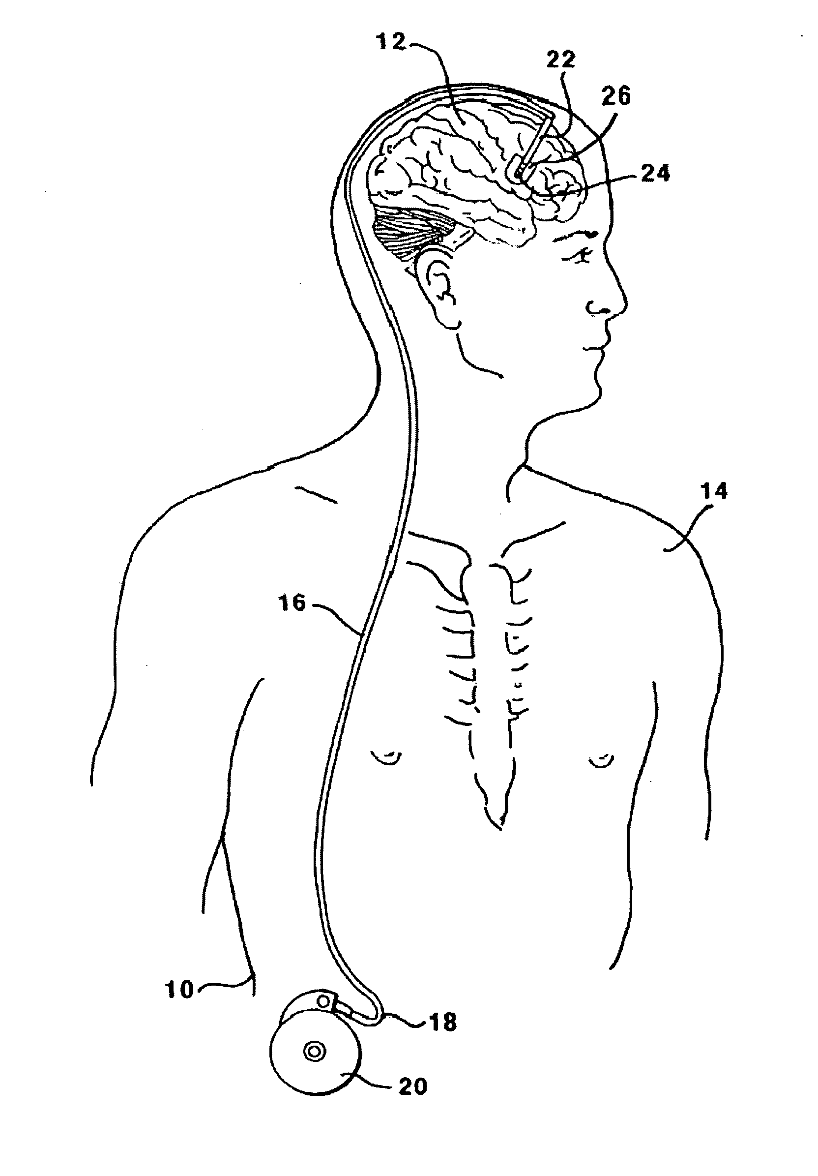 Methods and Systems for Treatment of Neurological Diseases of the Central Nervous System