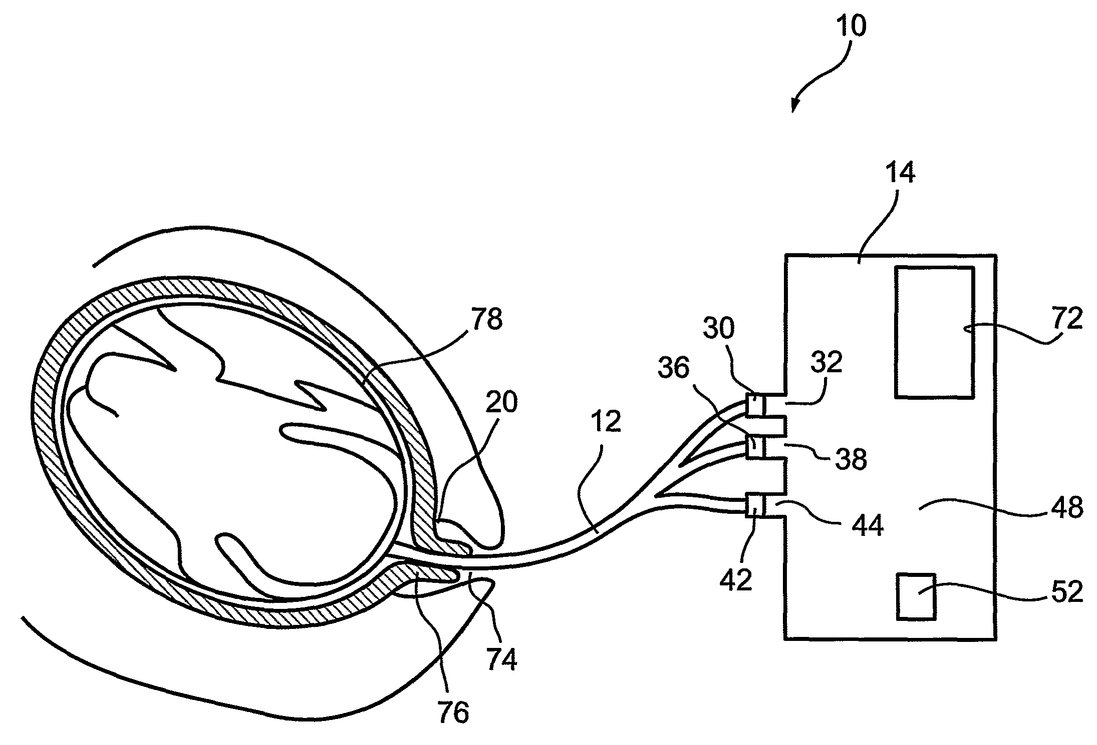 Device and method for identification of meconium in amniotic fluid