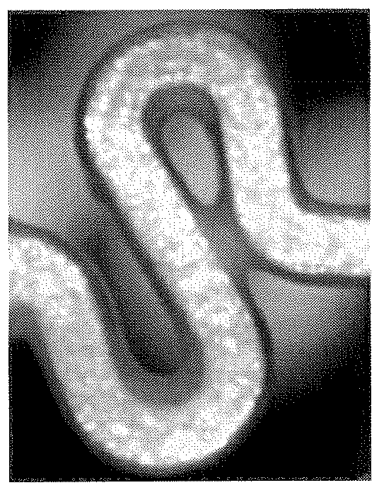 drug eluting stent