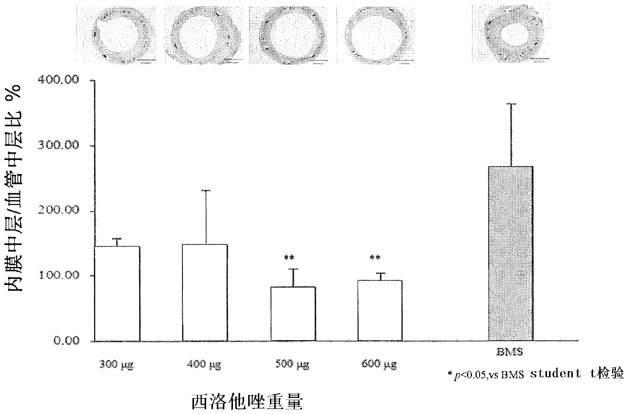 drug eluting stent