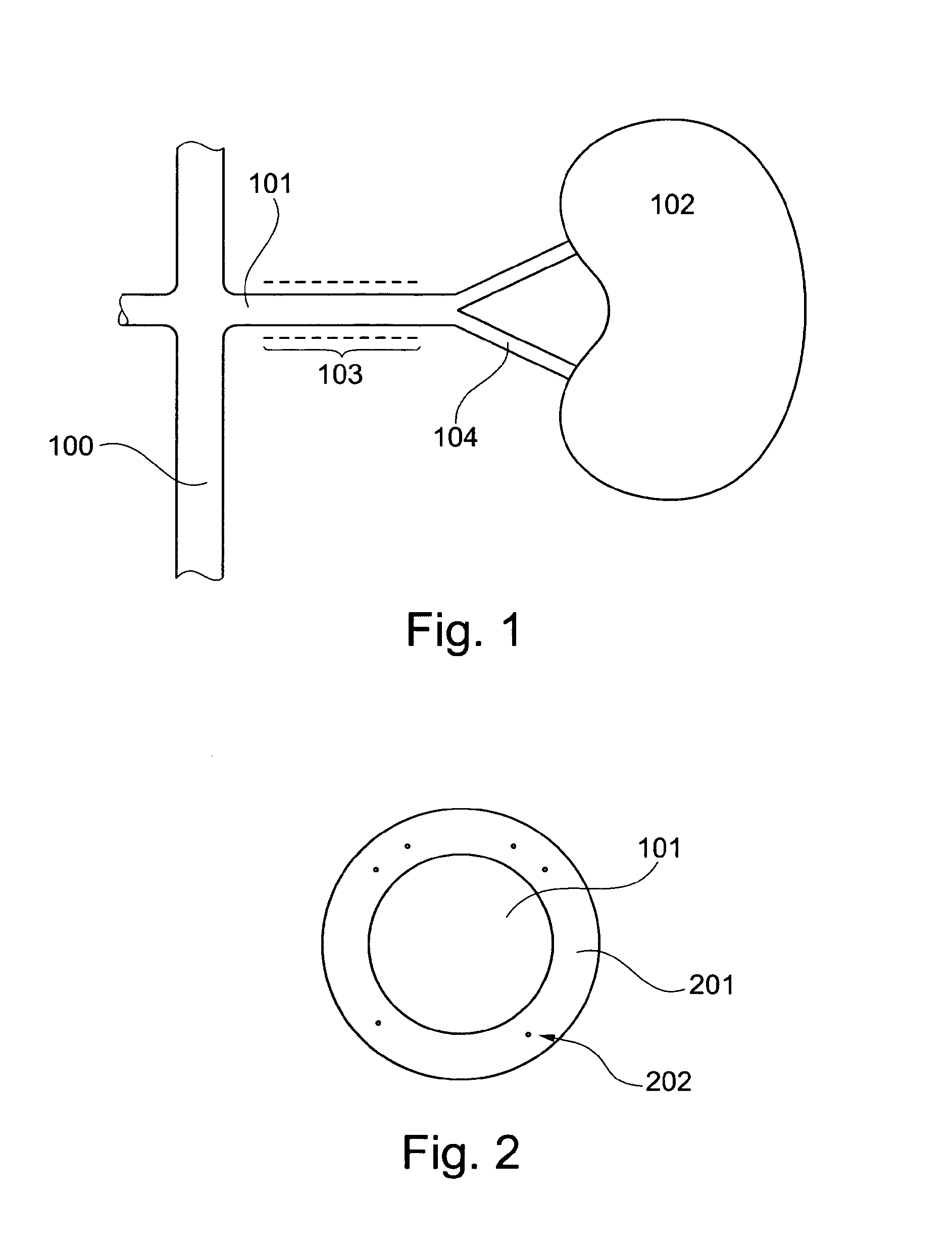 Device, And A Method For Treatment Of Increased Blood Pressure