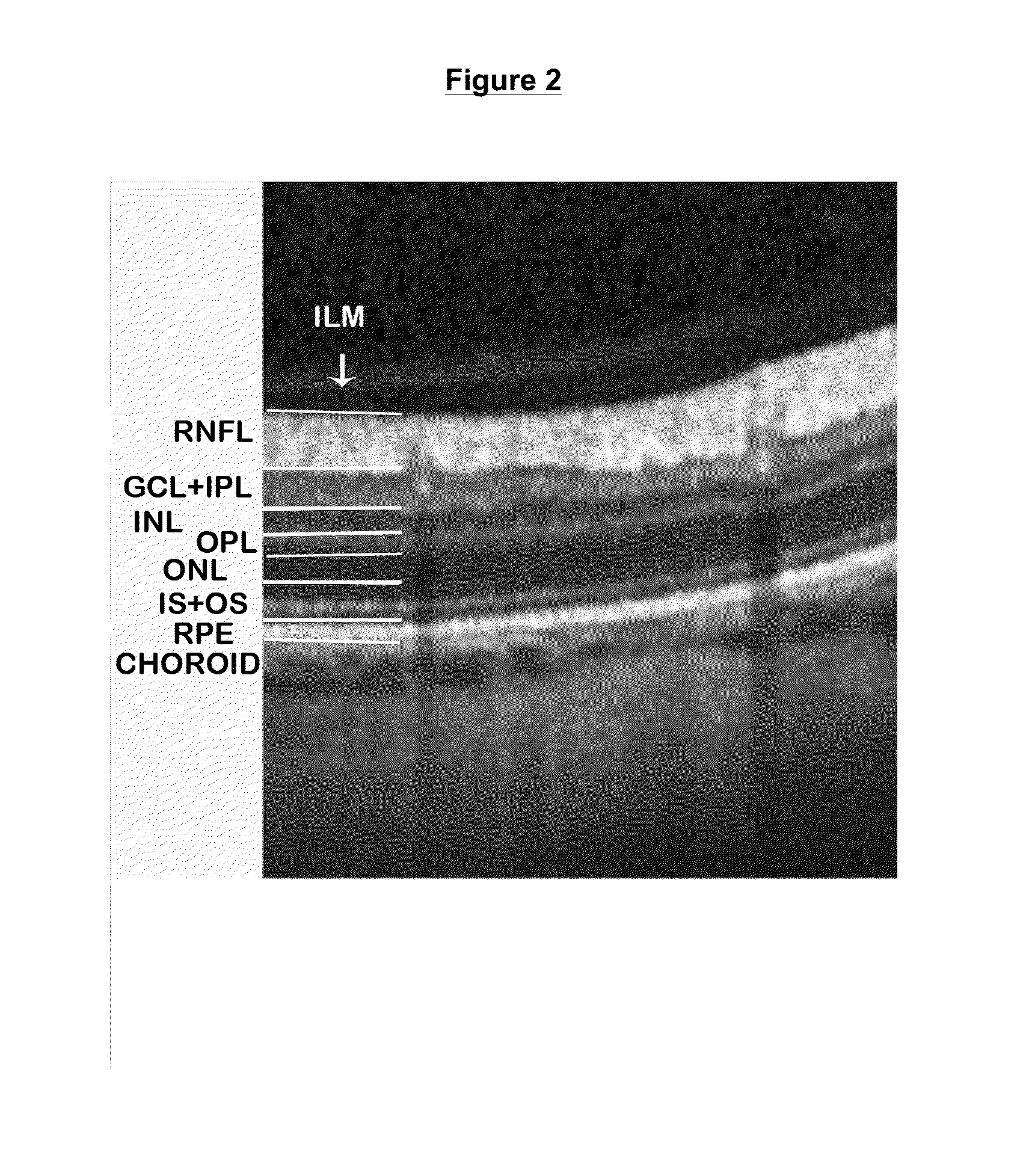 Method and System for Optic Nerve Head Shape Quantification