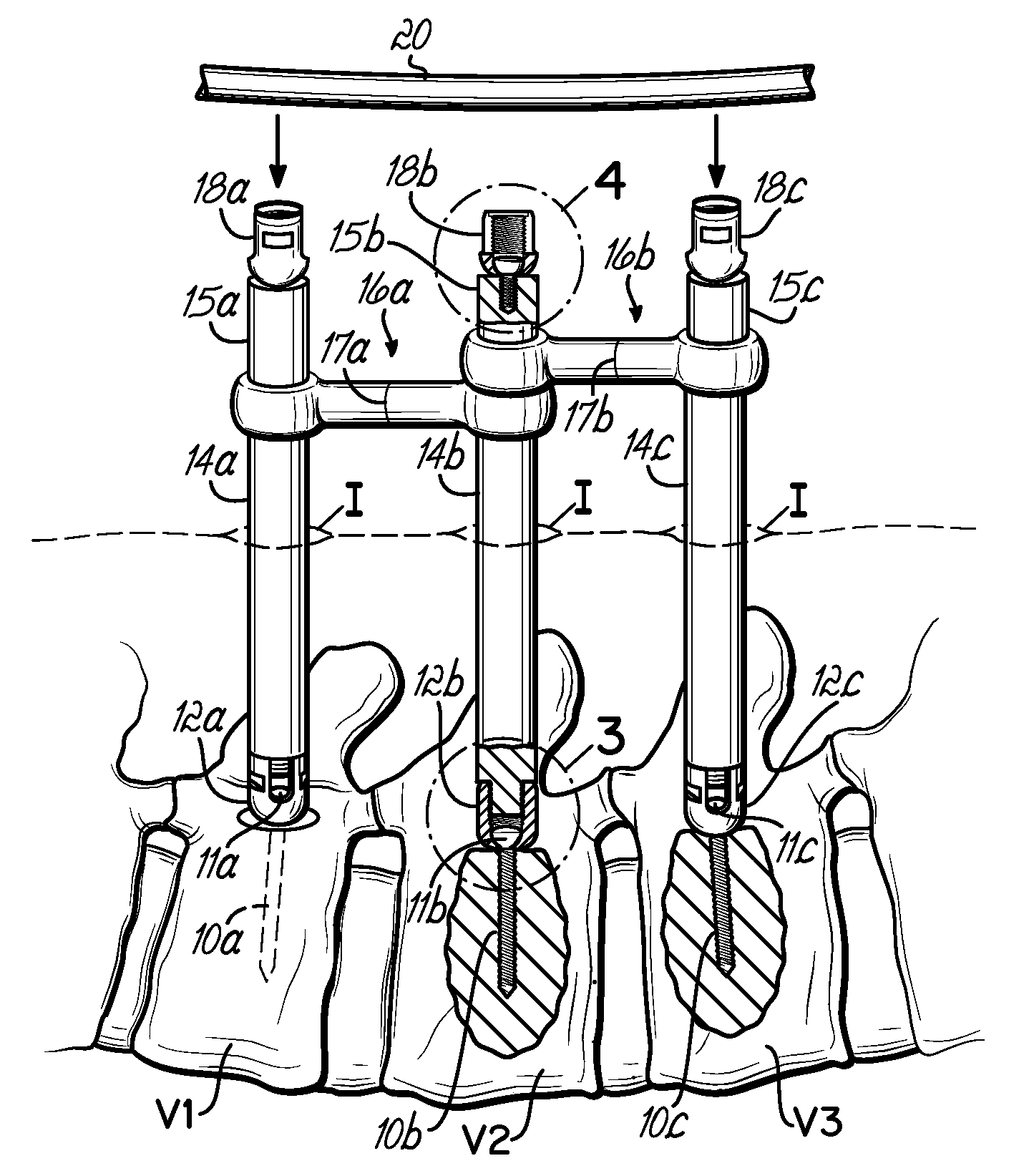 Pedicle fixation rod alignment system