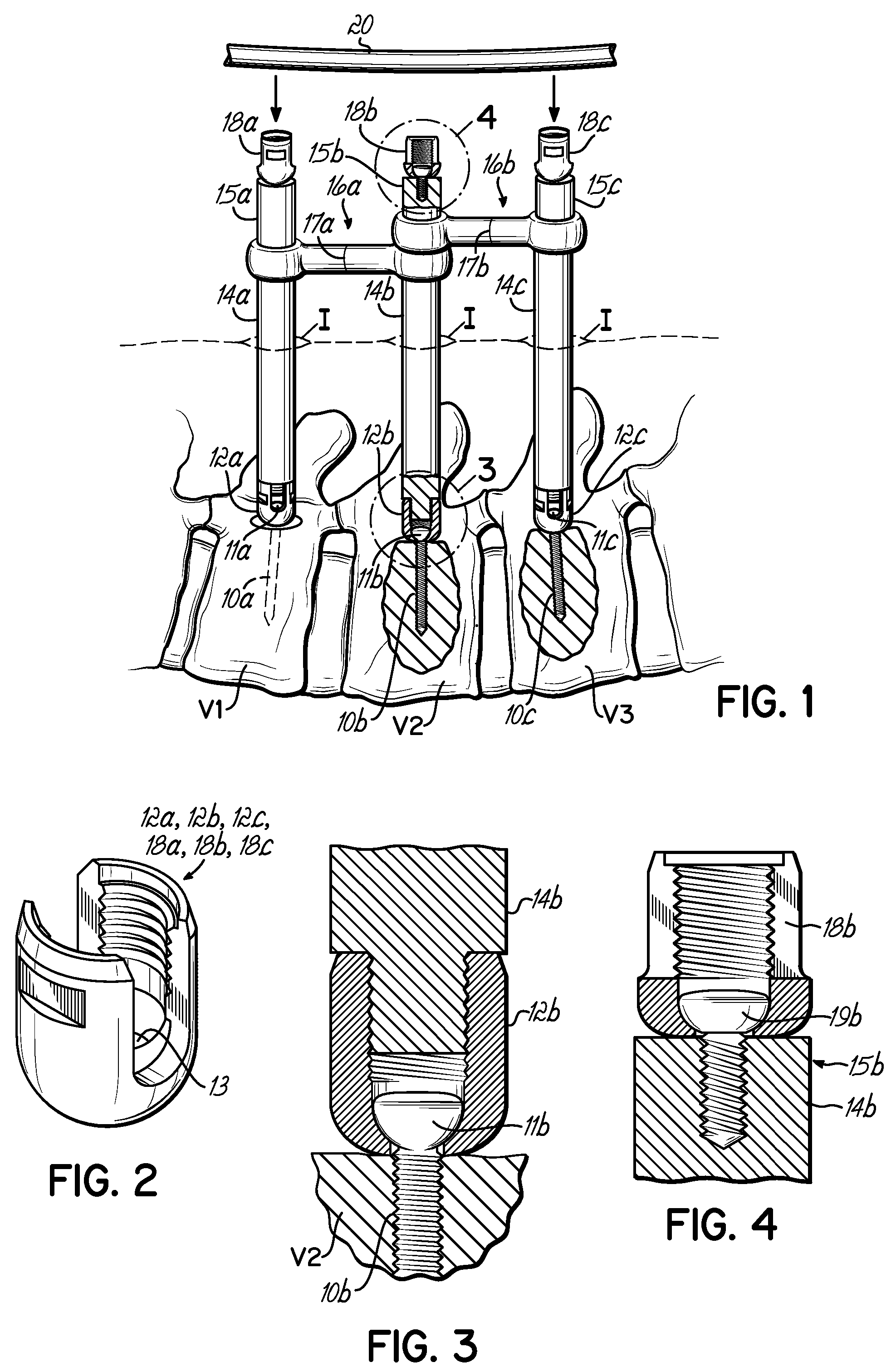 Pedicle fixation rod alignment system