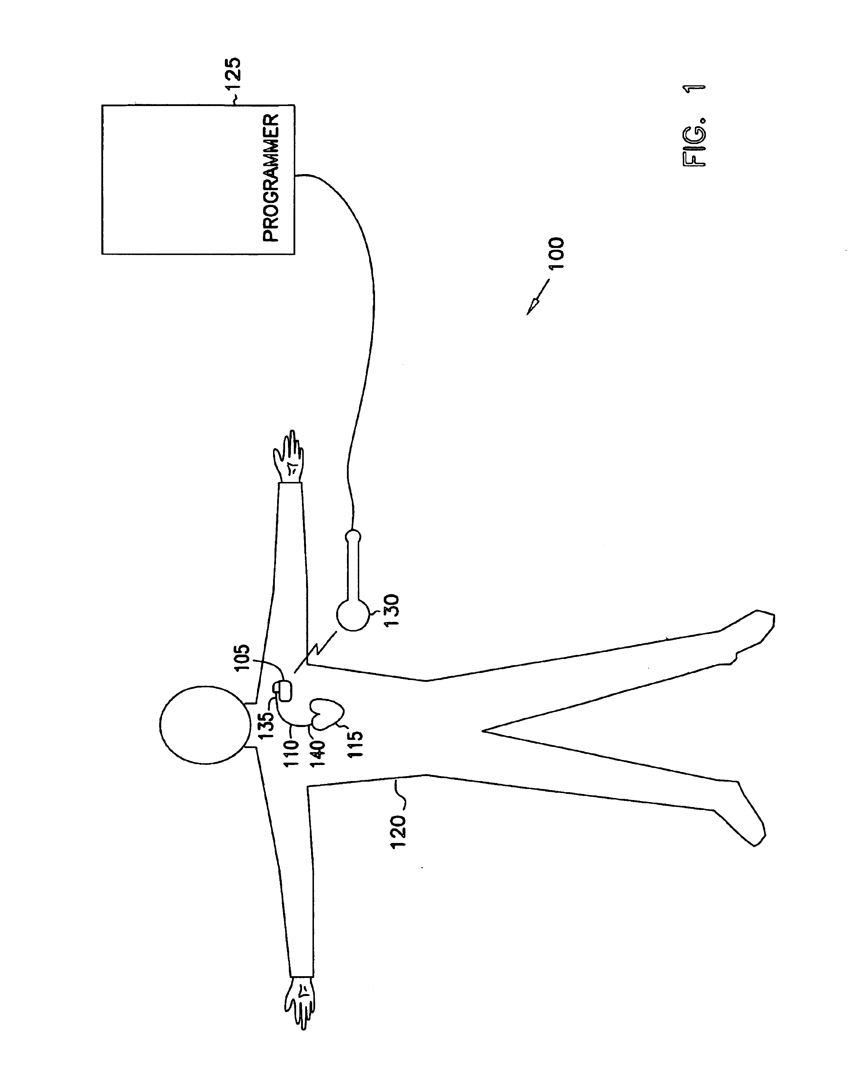 Method and apparatus for treating irregular ventricular contractions such as during atrial arrhythmia