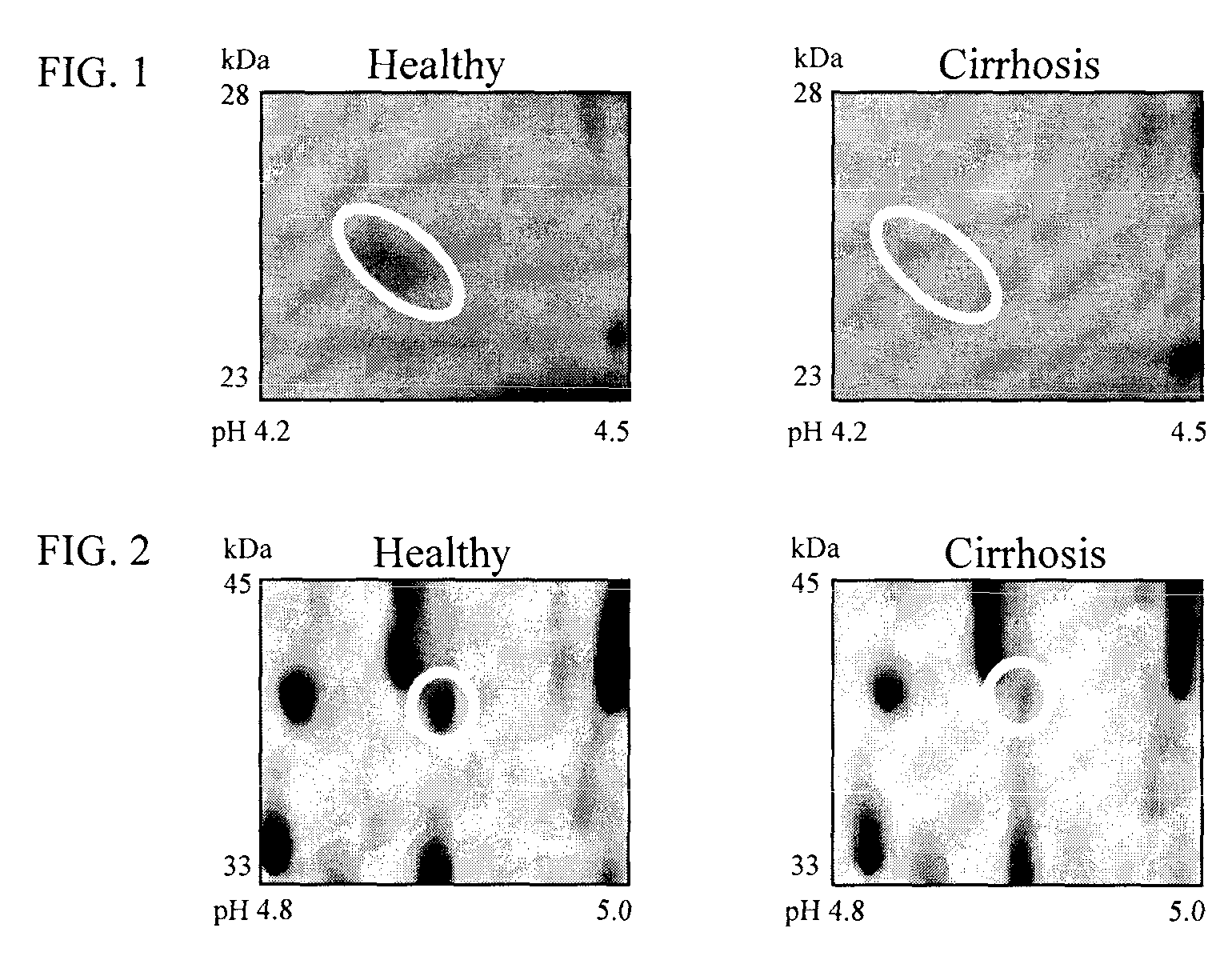 Clinical diagnosis of hepatic fibrosis using a novel panel of low abundant human plasma protein biomarkers