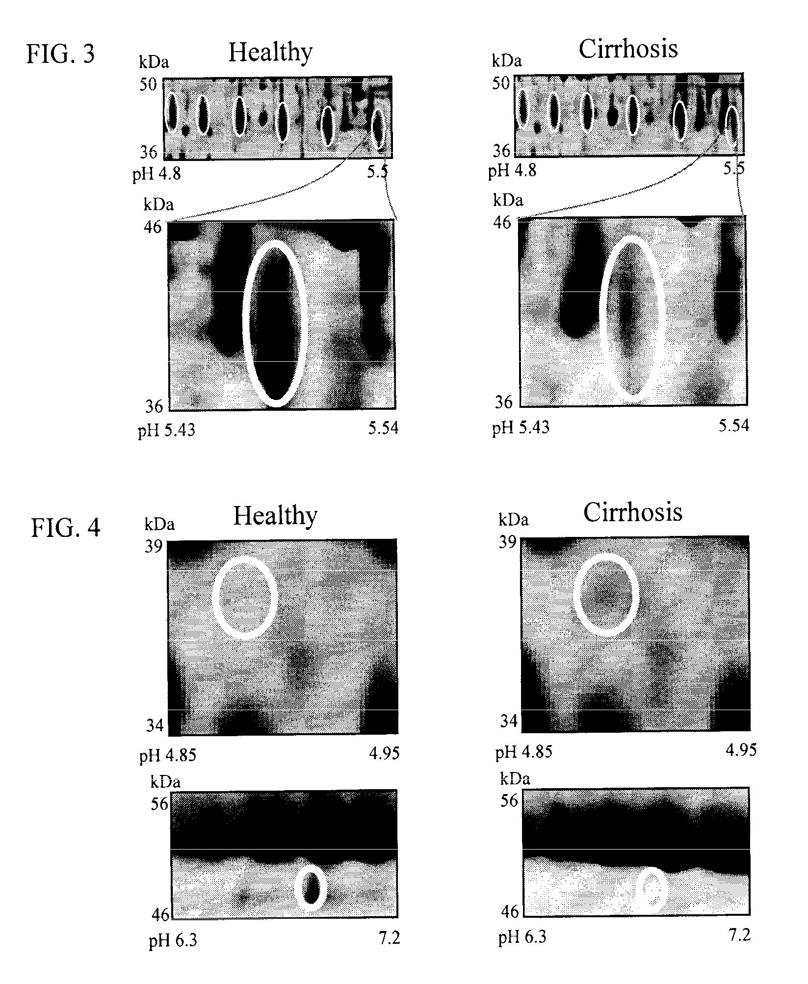 Clinical diagnosis of hepatic fibrosis using a novel panel of low abundant human plasma protein biomarkers