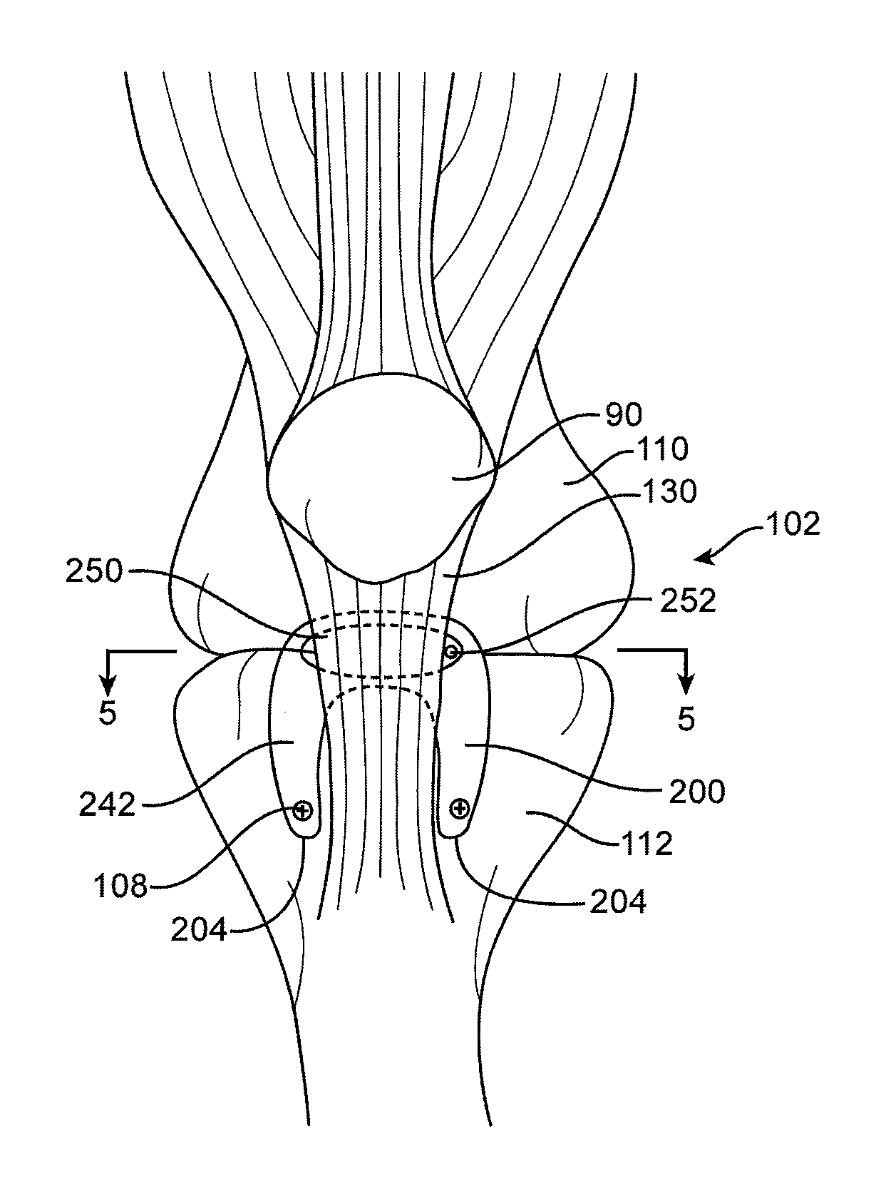 Spacers for Redistributing Forces for the Patella