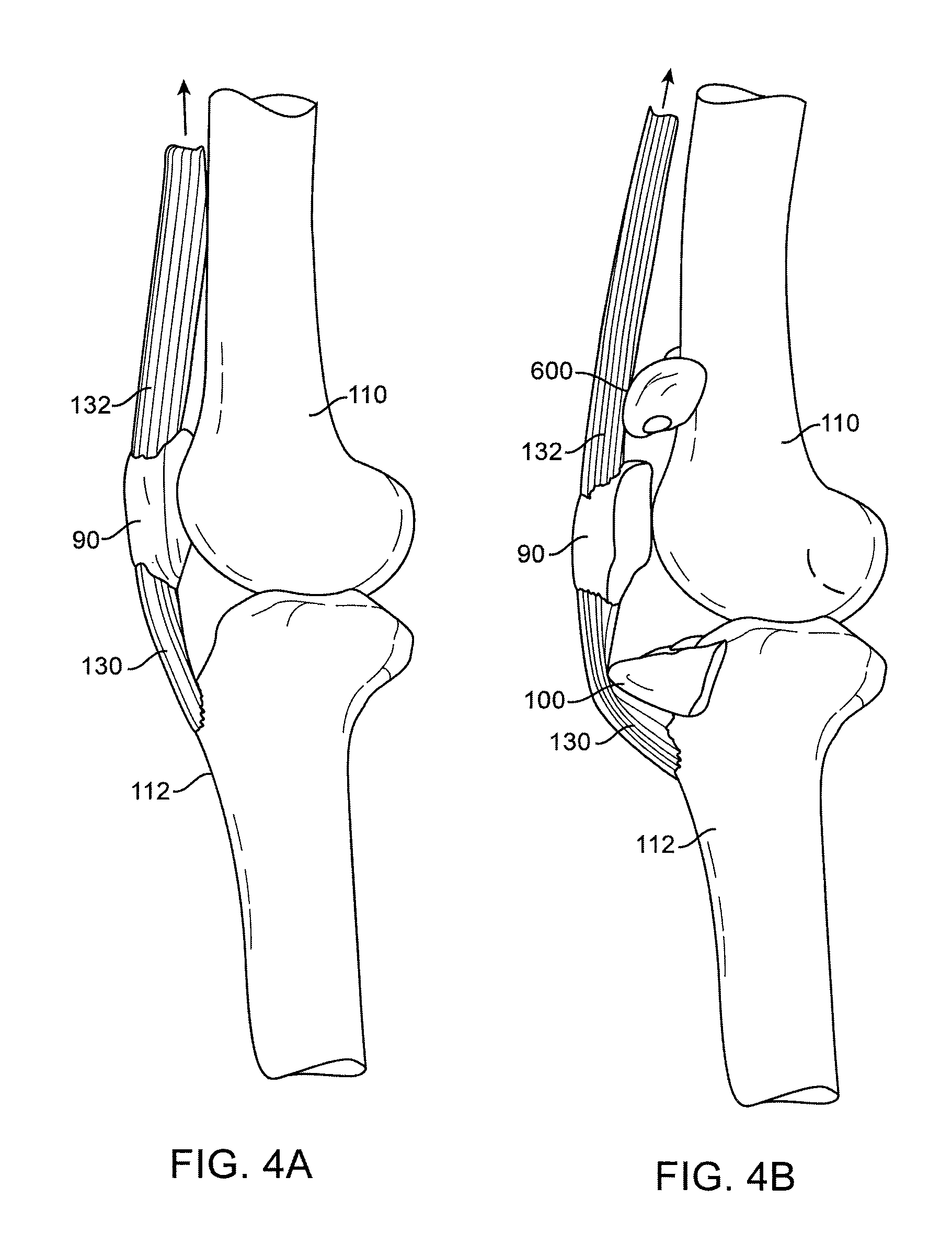 Spacers for Redistributing Forces for the Patella