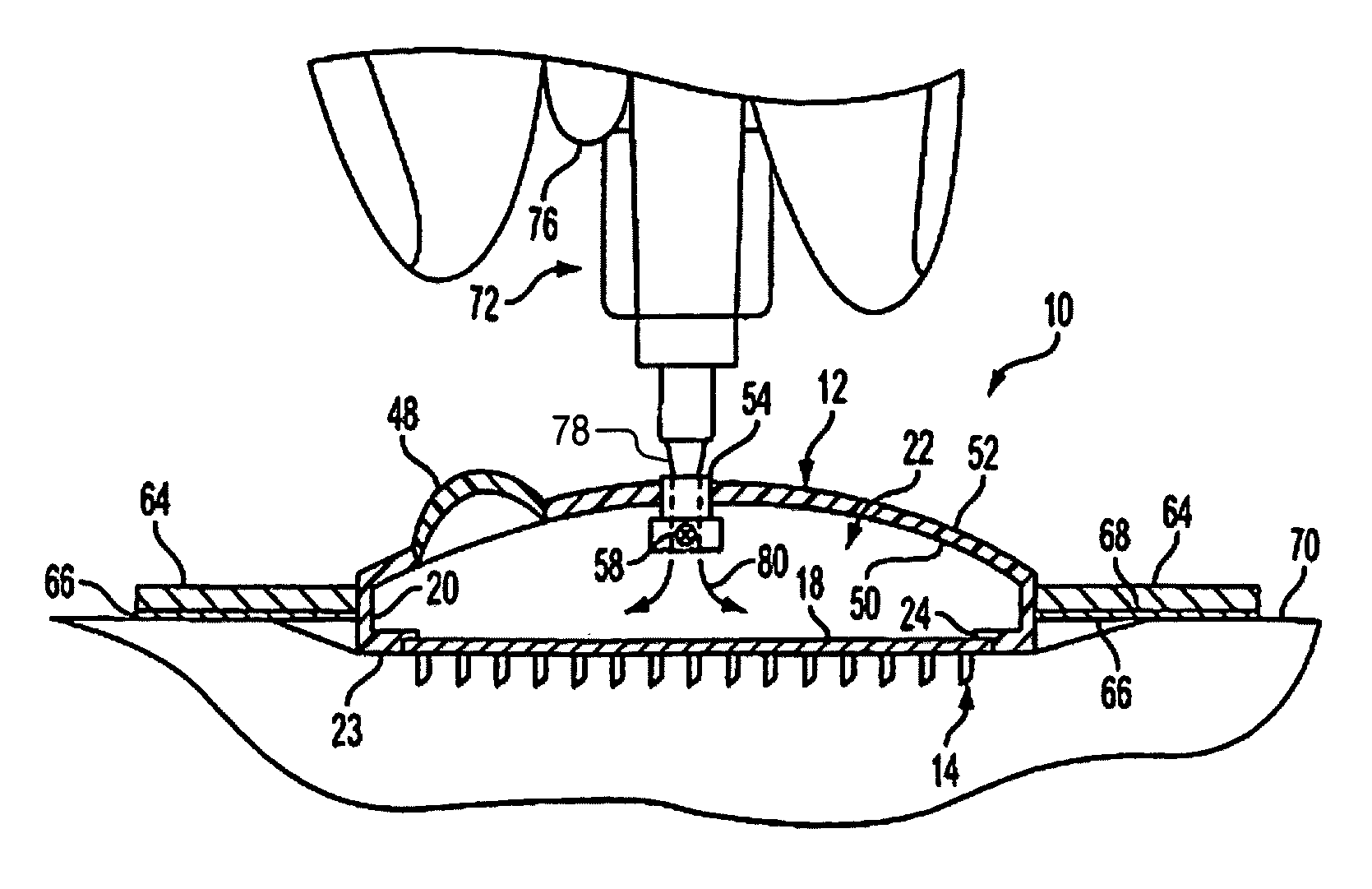 Method and device for intradermally delivering a substance