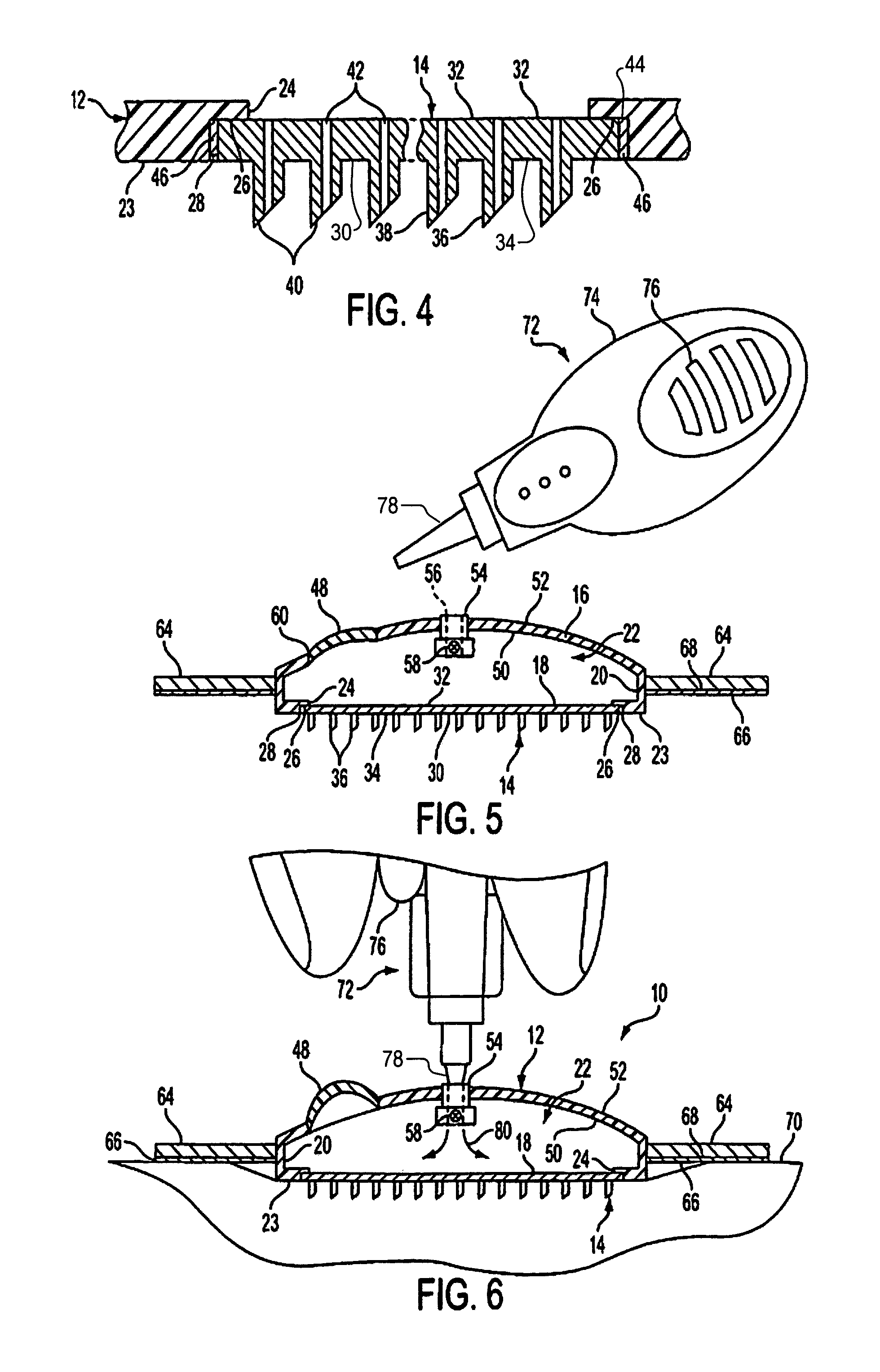 Method and device for intradermally delivering a substance