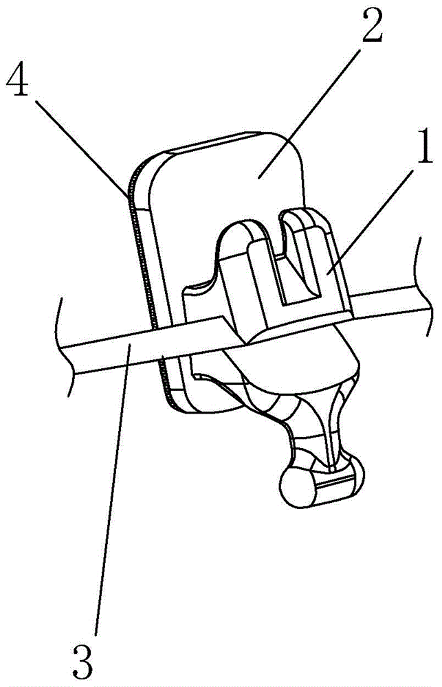 Manufacturing method of customized tongue-side invisible aligner