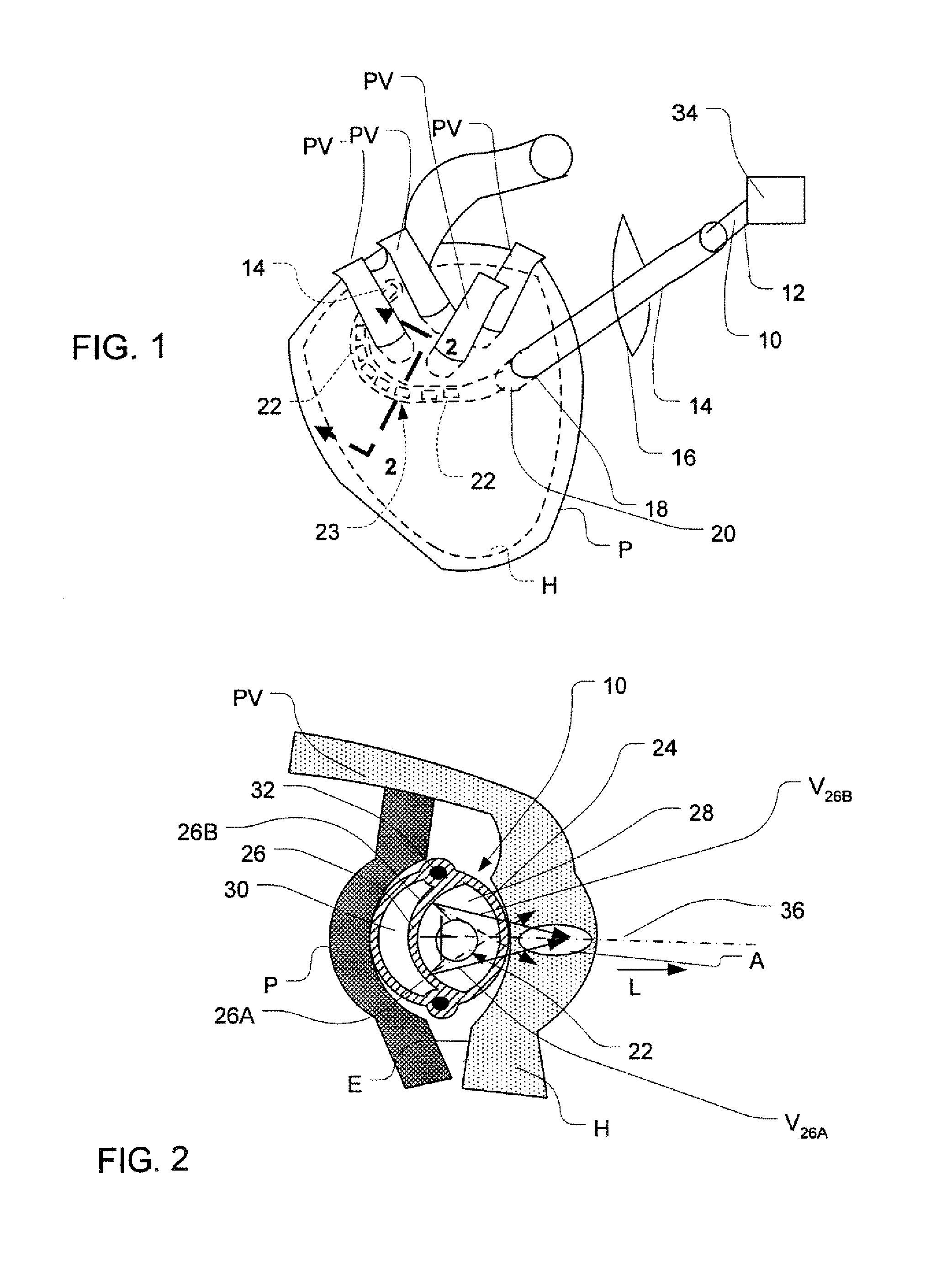 Epicardial ablation using focused ultrasound