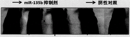 Application of miR-135b inhibitor to medicament for treating lung metastasis and relapse of osteosarcoma