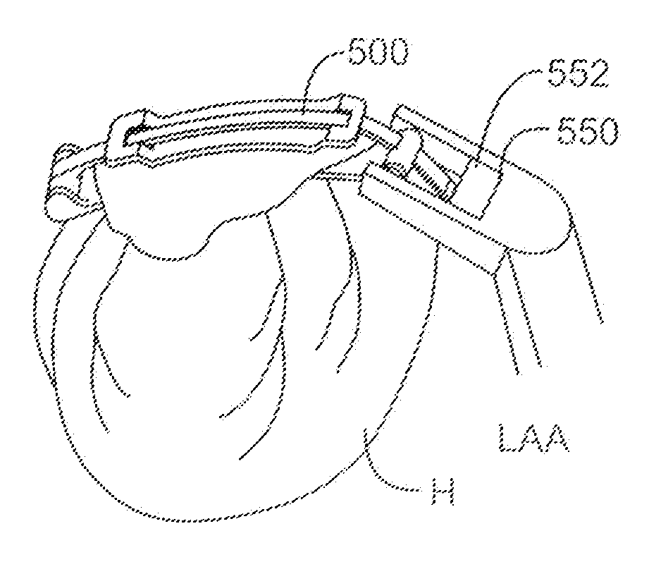 Left atrial appendage devices and methods