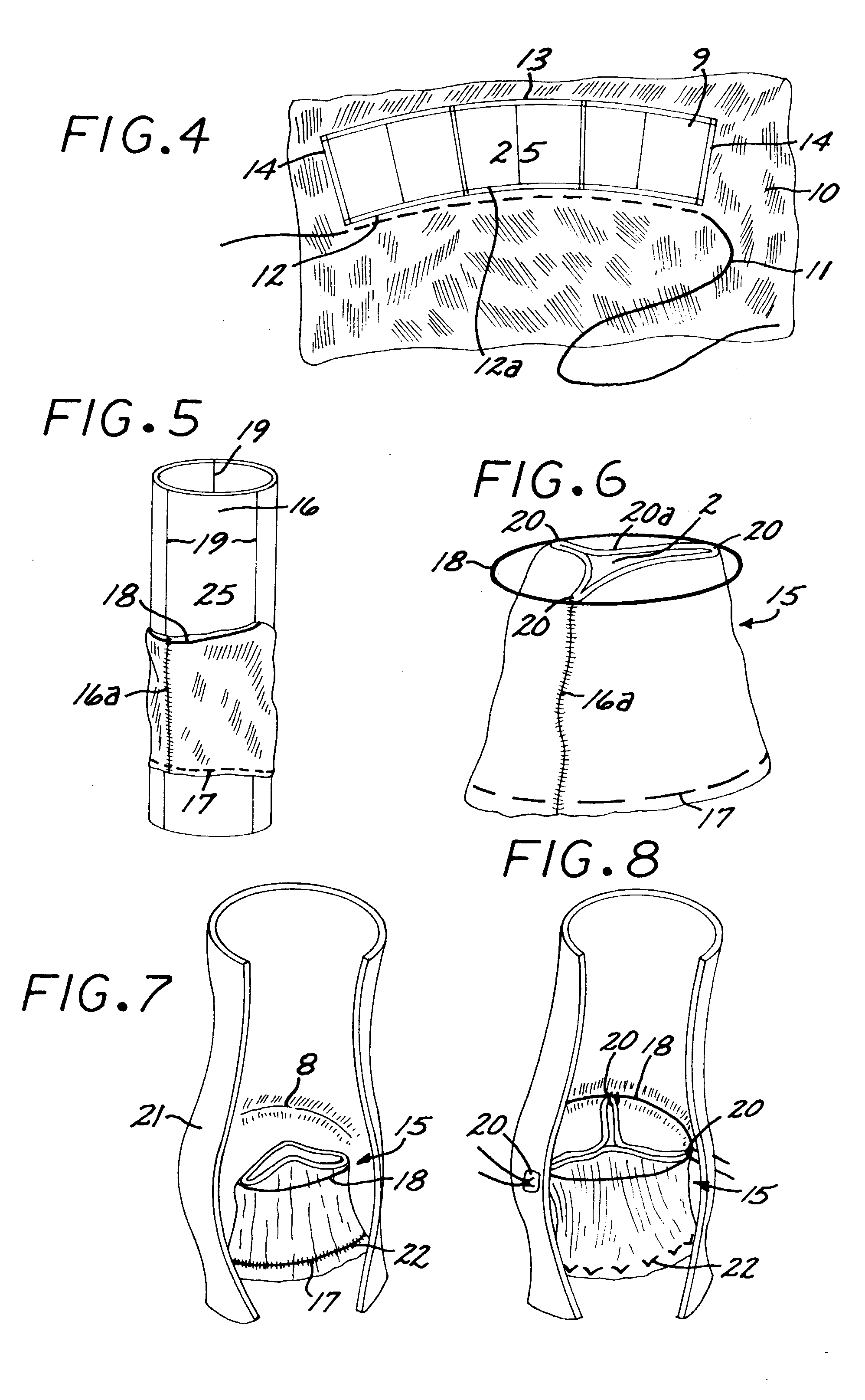 Reed valve for implantation into mammalian blood vessels and heart with optional temporary or permanent support