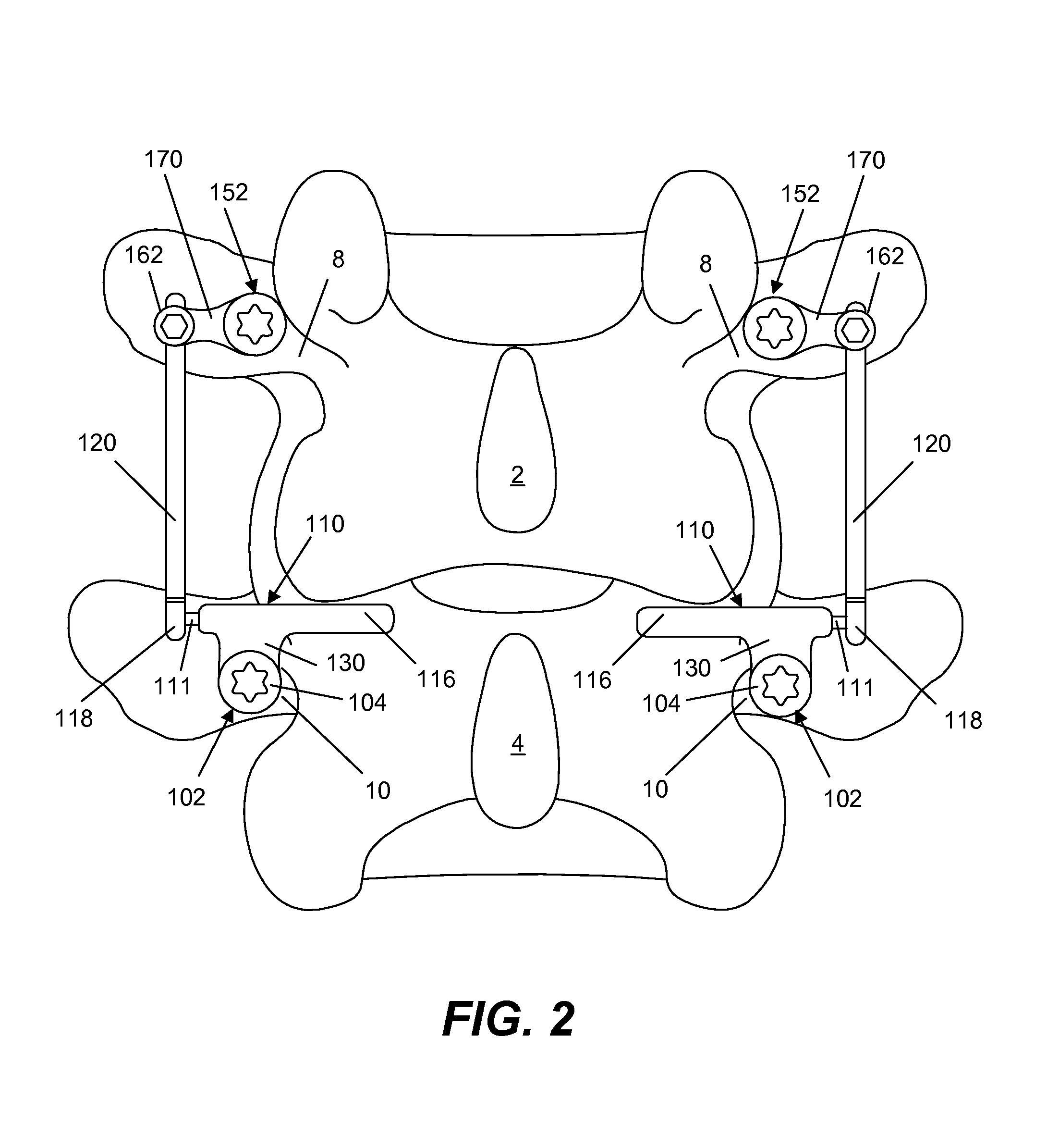 Spine implant with a dual deflection rod system including a deflection limiting sheild associated with a bone screw and method