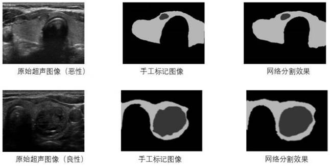 Thyroid nodule diagnosis method based on deep learning network