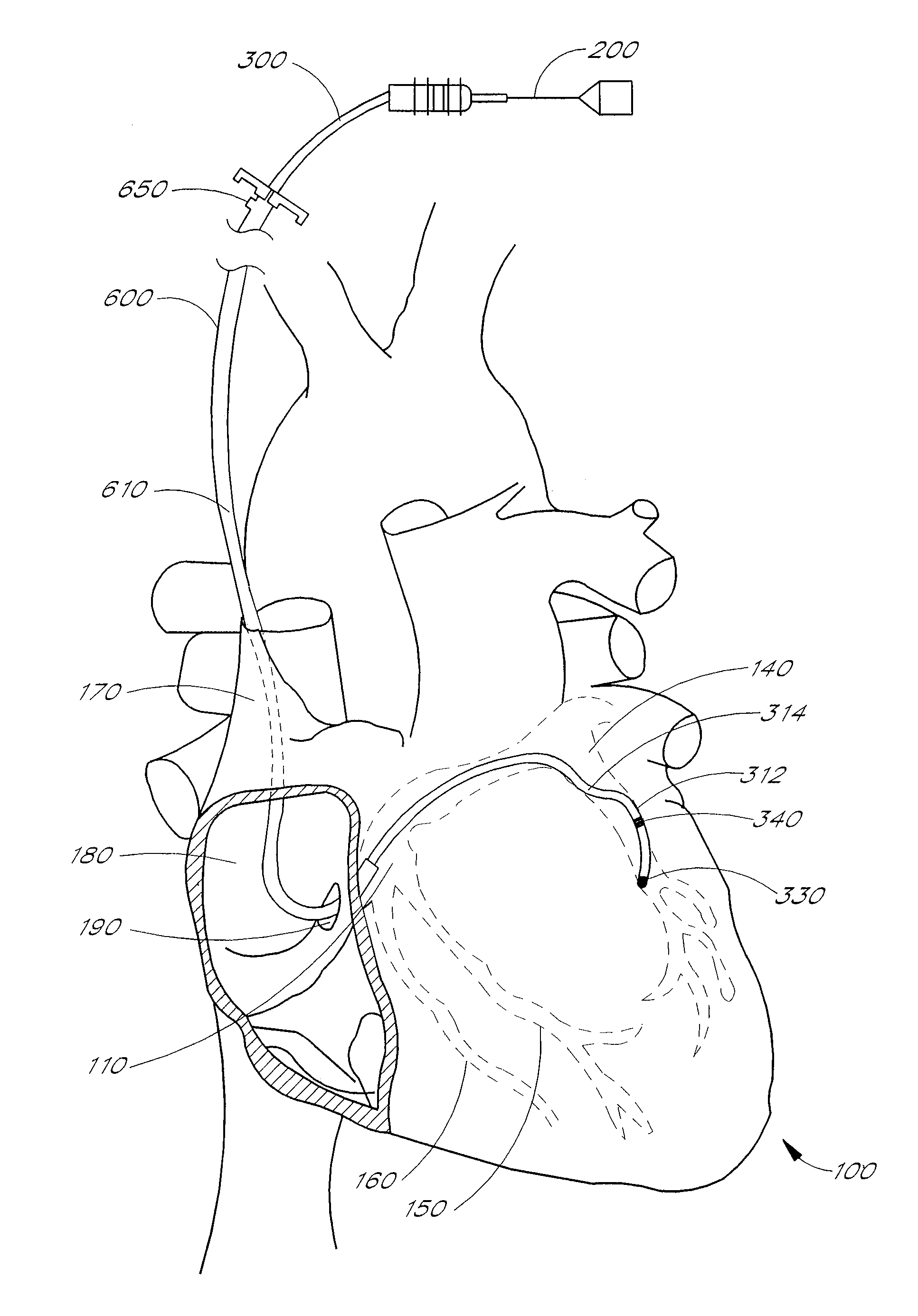 Self-anchoring coronary sinus lead