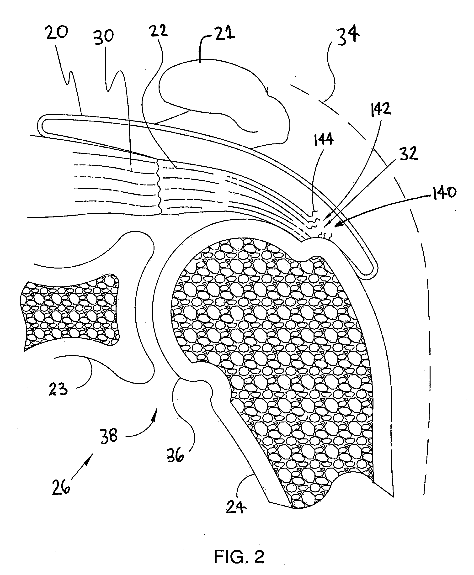 Implantable Tendon Protection Systems and Related Kits and Methods