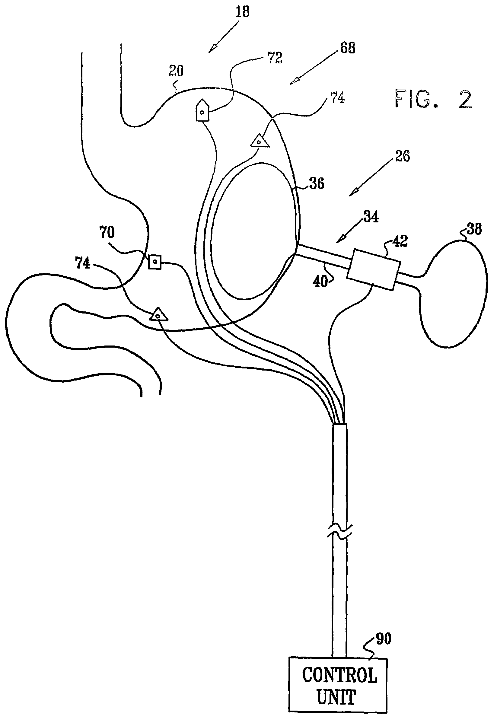 Gastrointestinal methods and apparatus for use in treating disorders
