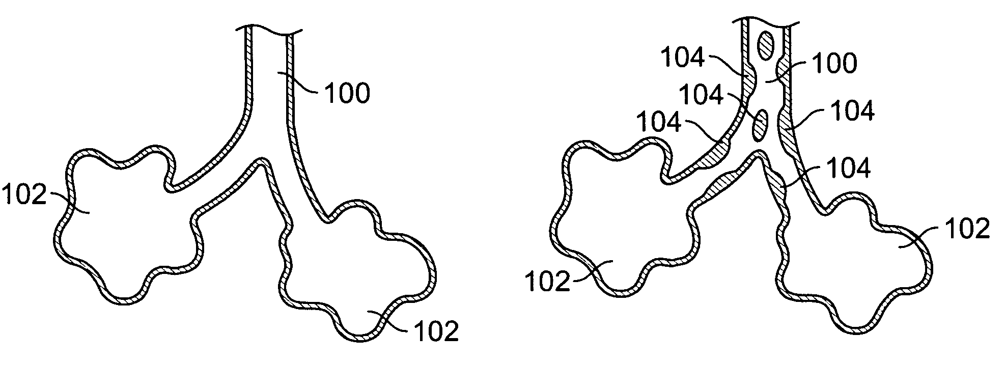 Methods and devices for maintaining patency of surgically created channels in a body organ