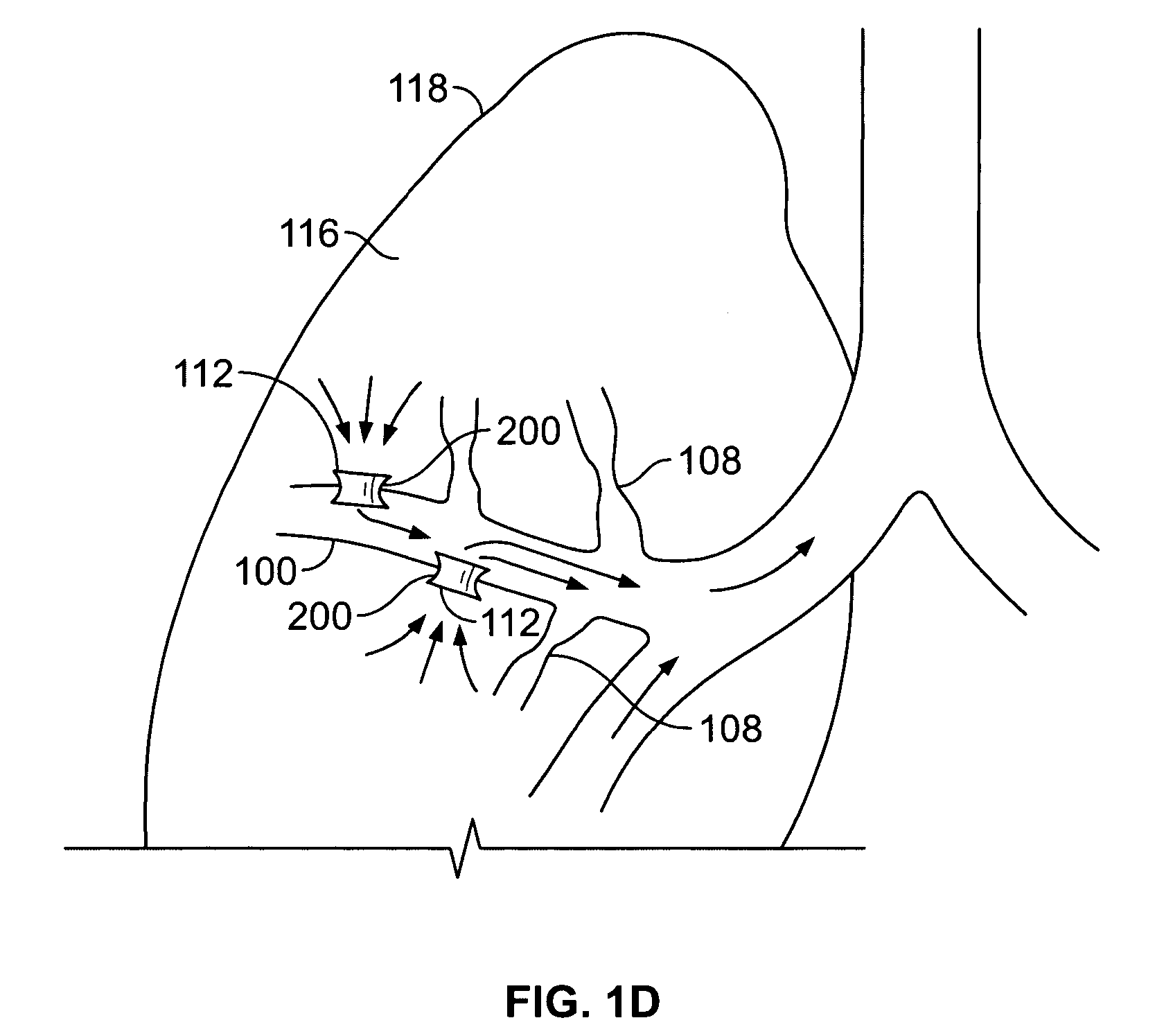 Methods and devices for maintaining patency of surgically created channels in a body organ