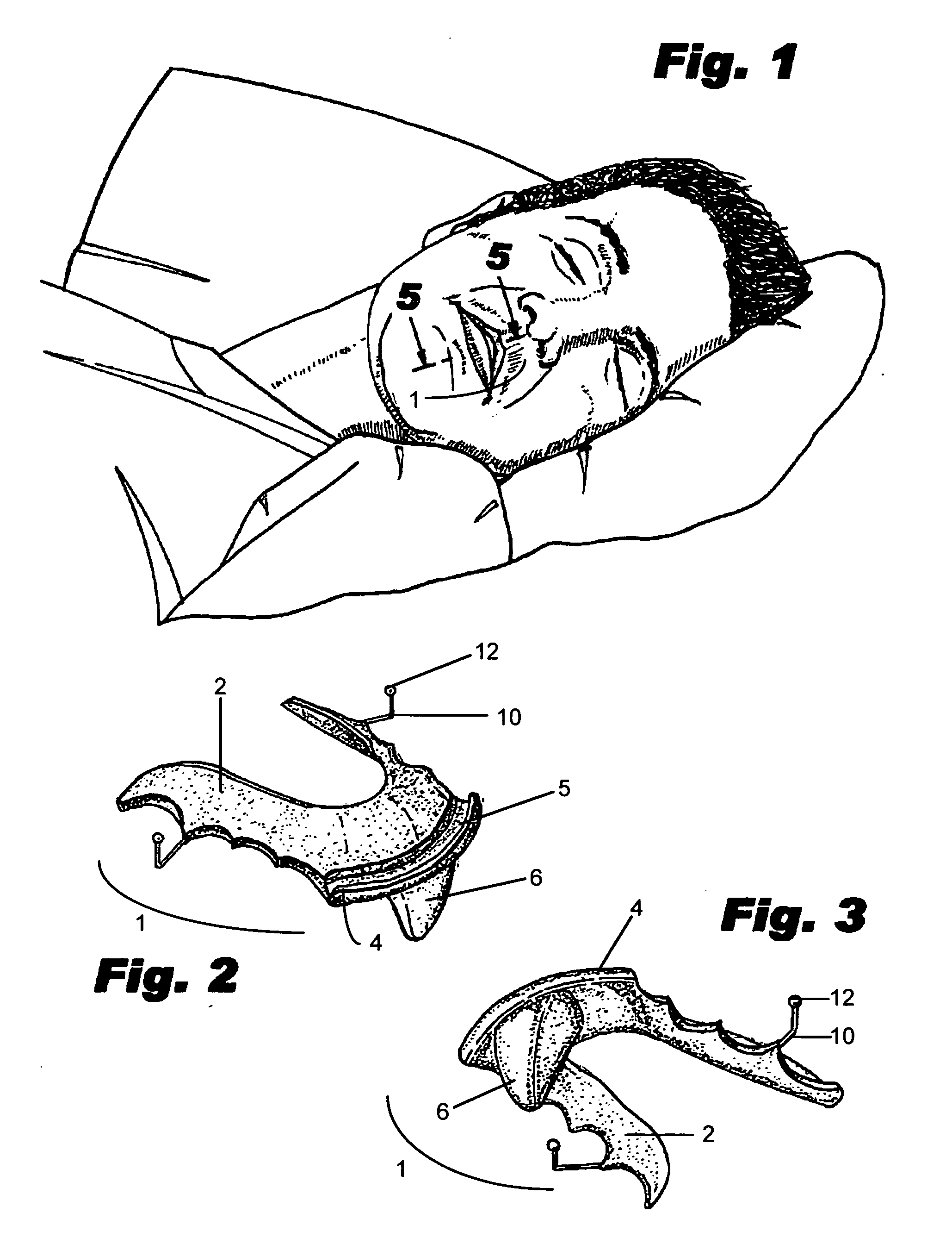 Intraoral mandibular advancement device for treatment of sleep disorders, including snoring, obstructive sleep apnea, and gastroesophageal reflux disease and method for delivering the same