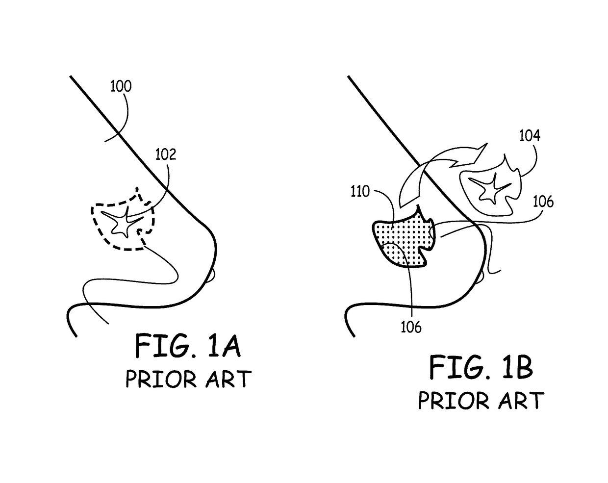 Implants and biodegradable tissue markers