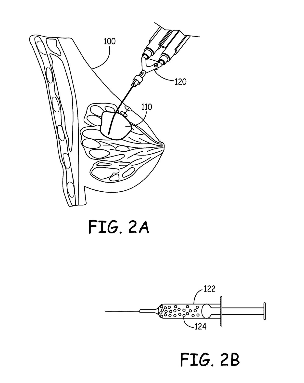 Implants and biodegradable tissue markers