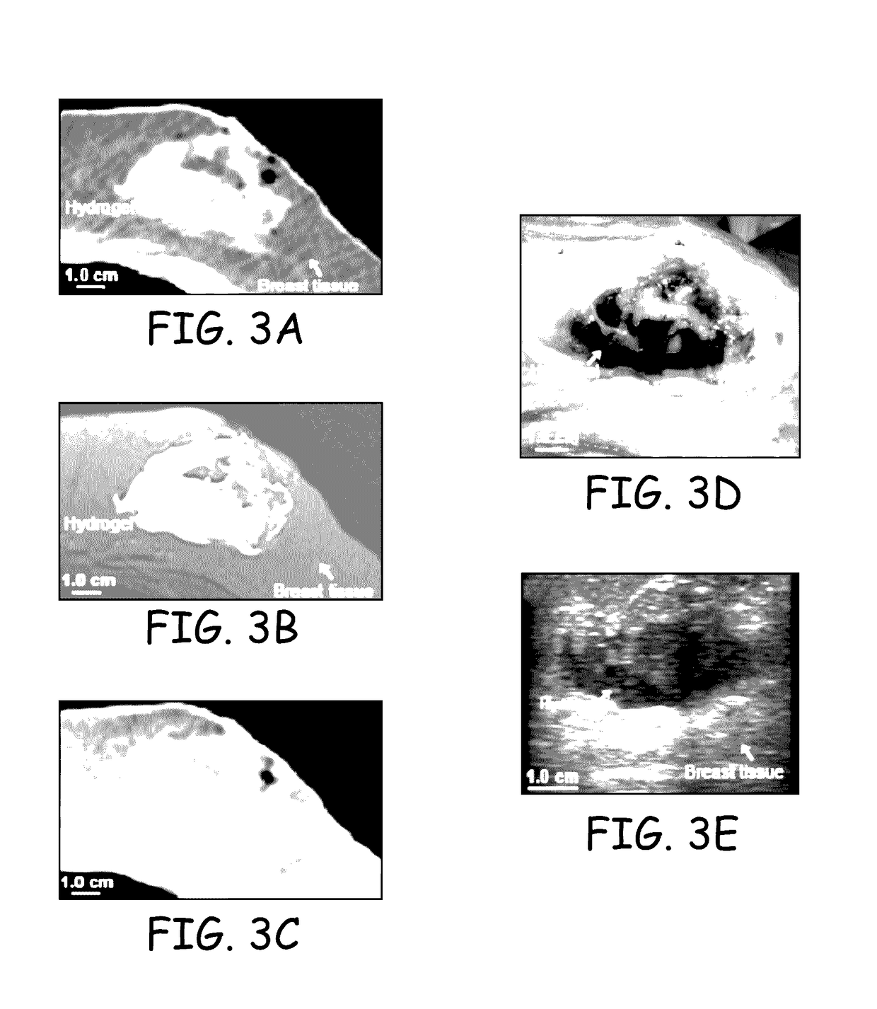 Implants and biodegradable tissue markers